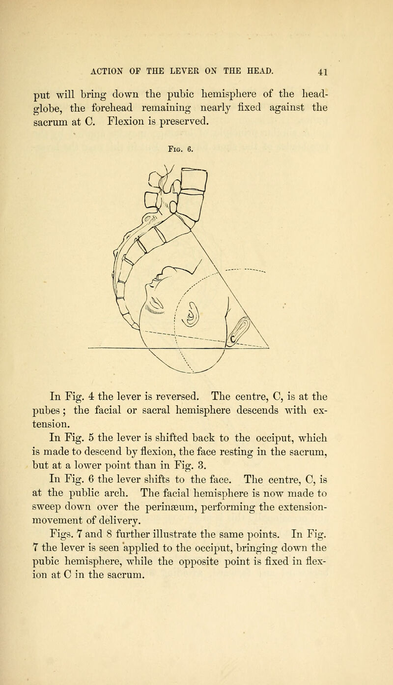 put will bring down the pubic bemispliere of the head- globe, the forehead remaining nearly fixed against the sacrum at C. Flexion is preserved. Fm. 6, In Fig. 4: the lever is reversed. The centre, C, is at the pubes; the facial or sacral hemisphere descends with ex- tension. In Fig. 5 the lever is shifted back to the occiput, which is made to descend by flexion, the face resting in the sacrum, but at a lower point than in Fig. 3. In Fig. 6 the lever shifts to the face. The centre, C, is at the public arch. The facial hemisphere is now made to sweep down over the perinseum, performing the extension- movement of delivery. Figs. Y and 8 further illustrate the same points. In Fig. 7 the lever is seen applied to the occiput, bringing down the pubic hemisphere, while the opposite point is fixed in flex- ion at C in the sacrum.