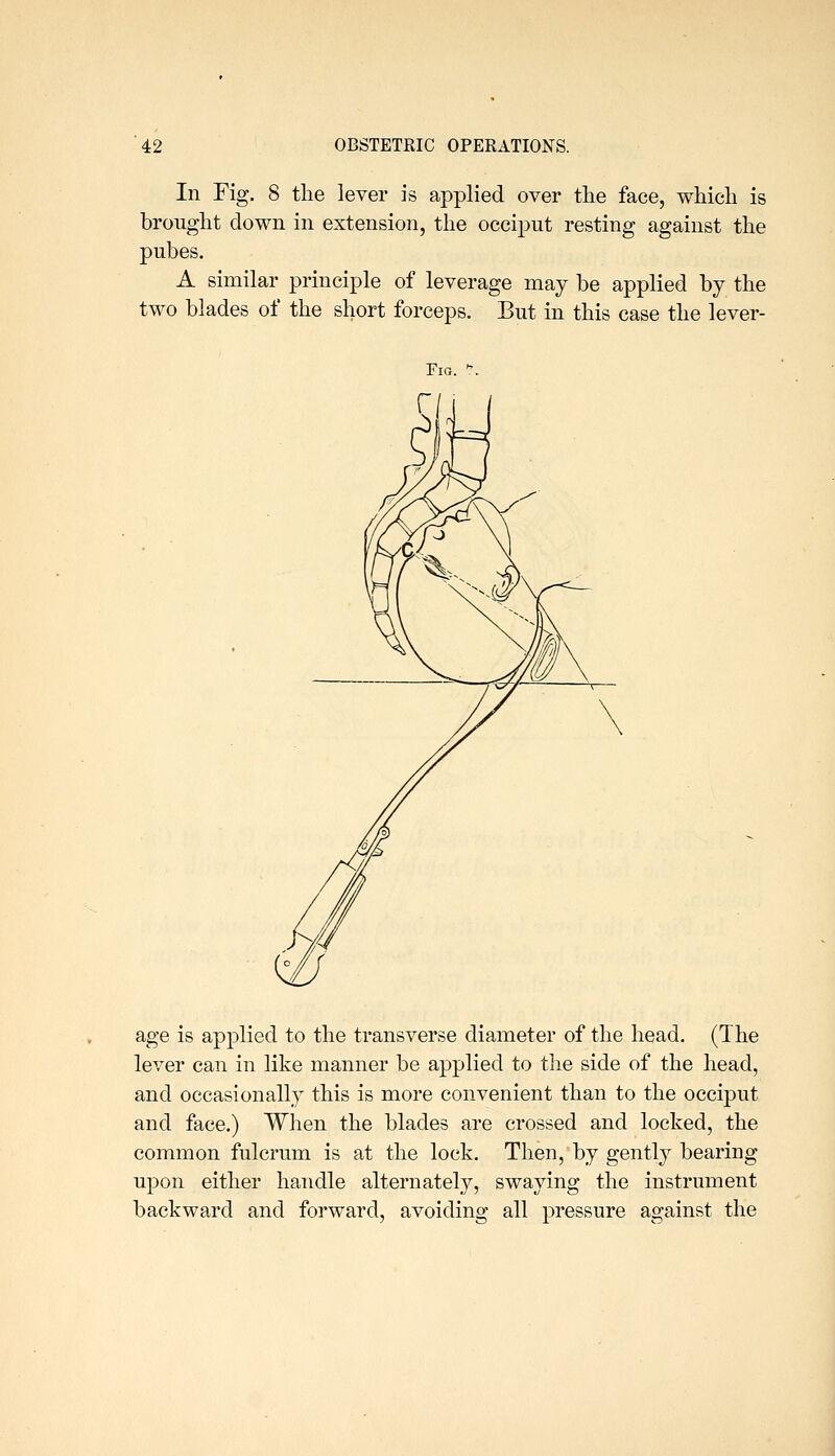 In Fig. 8 the lever is applied over tlie face, whicli is brought down in extension, the occiput resting against the pubes. A similar principle of leverage may be applied by the two blades of the short forceps. But in this case the lever- FlG. age is applied to the transverse diameter of the head. (The lever can in like manner be applied to the side of the head, and occasionally this is more convenient than to the occiput and face.) When the blades are crossed and locked, the common fulcrum is at the lock. Then, by gently bearing upon either handle alternately, swaying the instrument backward and forward, avoiding all pressure against the