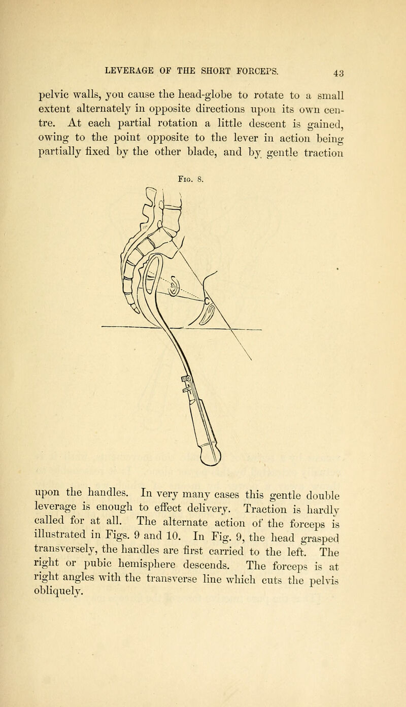 pelvic walls, you cause the head-globe to rotate to a small extent alternately in opposite directions upon its own cen- tre. At each partial rotation a little descent is gained owing to the point opposite to the lever in action being partially iixed by the other blade, and by gentle traction Fig. 8. upon the handles. In very many cases this gentle double leverage is enough to effect delivery. Traction is hardly called for at all. The alternate action of the forceps is illustrated in Figs. 9 and 10. In Fig. 9, the head grasped transversely, the handles are first carried to the left. The right or pubic hemisphere descends. The forceps is at right angles with the transverse line which cuts tlie pelvis obliquely.