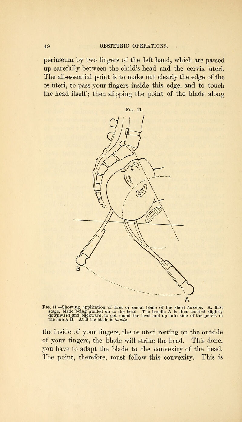 perinseum by two fingers of the left hand, which are passed up carefully between the child's head and the cervix uteri. The all-essential point is to make out clearly the edge of the OS uteri, to pass your fingers inside this edge, and to touch the head itself; then slipping the point of the blade along Fig Fig. 11.—Showing application of first or sacral blade of the short forceps. A, first stage, blade being guided on to the head. The handle A is then carried slightly downward and backward, to get round the head and up into side of the pelvis in the line A B. At B the blade is in situ. the inside of your fingers, the os uteri resting on the outside of your fingers, the blade will strike the head. This done, you have to adapt the blade to the convexity of the head. The point, therefore, must follow this convexity. This is