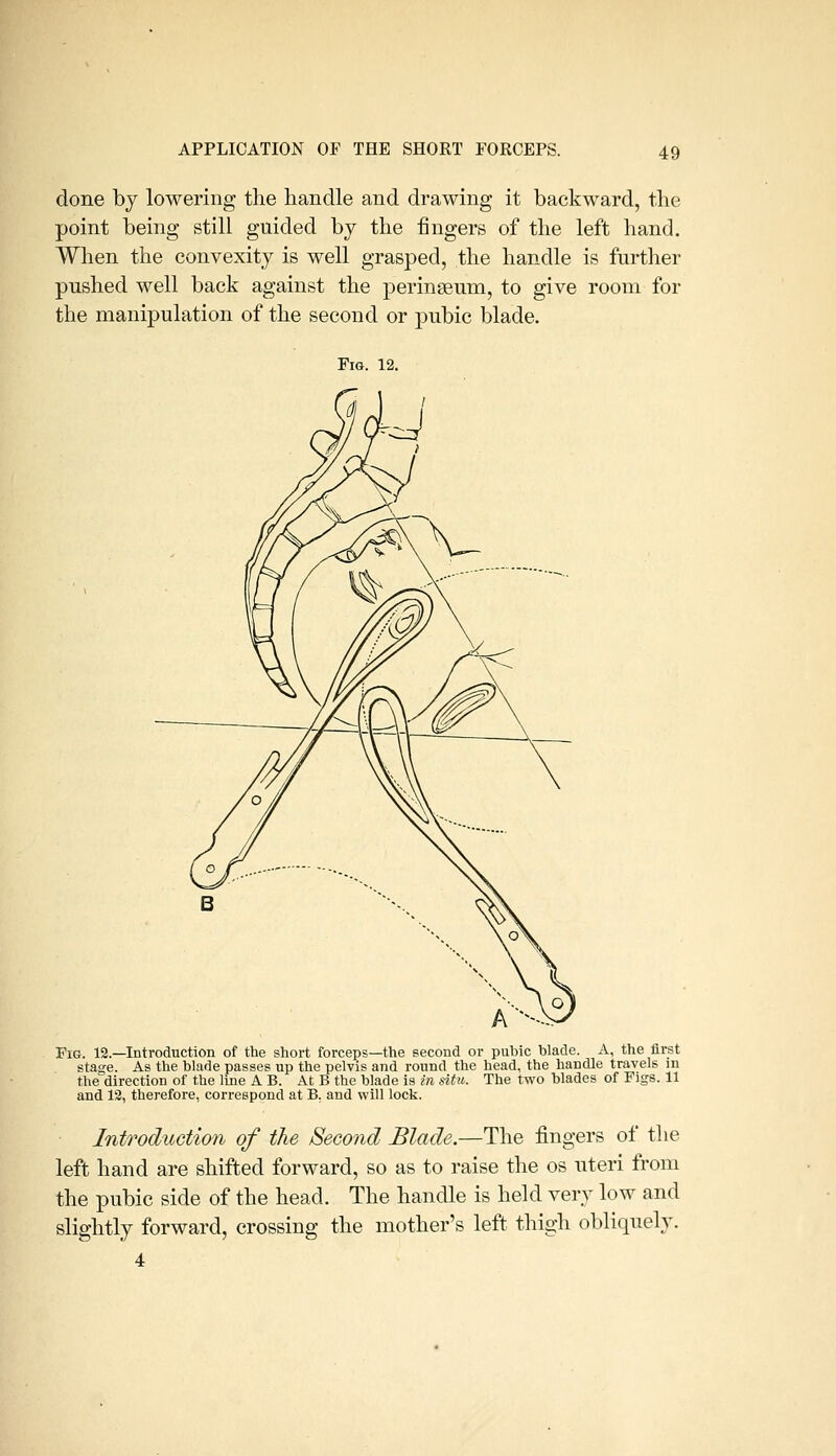 done by lowering the handle and drawing it backward, the point being still guided by the fingers of the left hand. When the convexity is well grasped, the handle is further pushed well back against the perinseum, to give room for the manipulation of the second or pubic blade. Fig. 12. Fig. 12.—Introduction of the short forceps—the second or pubic blade. A, the first stase. As tlie blade passes up the pelvis and round the head, the liandle travels in the'direction of the line A B. At B the blade is in situ. The two blades of Figs. 11 and 13, therefore, correspond at B, and will lock. Introduction of the Second Blade.—The fingers of the left hand are shifted forward, so as to raise the os uteri from the pubic side of the head. The handle is held very low and slightly forward, crossing the mother's left thigh obliquely. 4