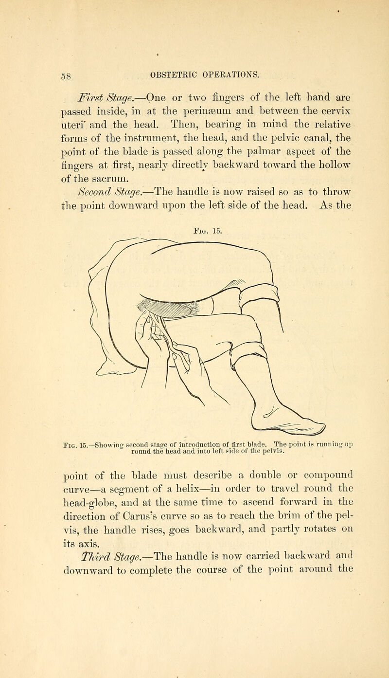 First Stage.—One or two fingers of the left hand are passed inside, in at the perinoeum and between the cervix uteri' and the head. Then, bearing in mind the relative forms of the instrmnent, the head, and the pelvic canal, the point of the blade is passed along the palmar aspect of the fingers at first, nearly directlv backward toward the hollow of the sacrum. Second Stage.—The handle is now raised so as to throw the point downward upon the left side of the head. As the Fig. 15. Fig. 15.—Showing second stage of introduction of first blade. The point is running up round the head and into left side of the pelvis. point of the blade must describe a double or compound curye—a segment of a helix—in order to travel round the head-globe, and at the same time to ascend forward in the direction of Carus's curve so as to reach the brim of the pel- vis, the handle rises, goes backward, and partly rotates on its axis. TktTd Stage.—The handle is now carried backward and downward to complete the course of the point around the