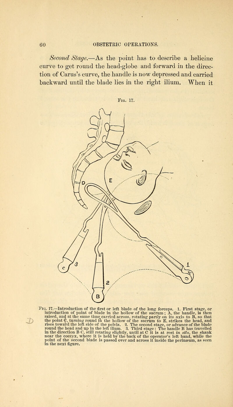 Second Stage.—As the point has to describe a heliciiie curve to get round the head-globe and forward in the direc- tion of Carus's curve, the handle is now depressed and carried backward until the blade lies in the right ilium. When it Fig. 17. Pig. 17.—Introduction of the firBt or left blade of the long forceps. 1. First stage, or introduction of point of blade in the hollow of the sacrum; A, the handle, is then raised, and at the same time^ carried across, rotating partly on its axis to B, so that /j the point C, turning round in the hollow of the sacrum to E, strikes the head, and rises toward the left side of the pelvis. 2. The second stage, or advance of the blade round the head and up in the left ilium. .3. Third stage : The handle B has travelled in the direction B C, still rotating slightly, until at C it is at rest in situ, the shank near the coccyx, where it is held by the back of the operator's left hand, while the point of the second blade is passed over and across it inside the perinaeum, as seen in the next figure.