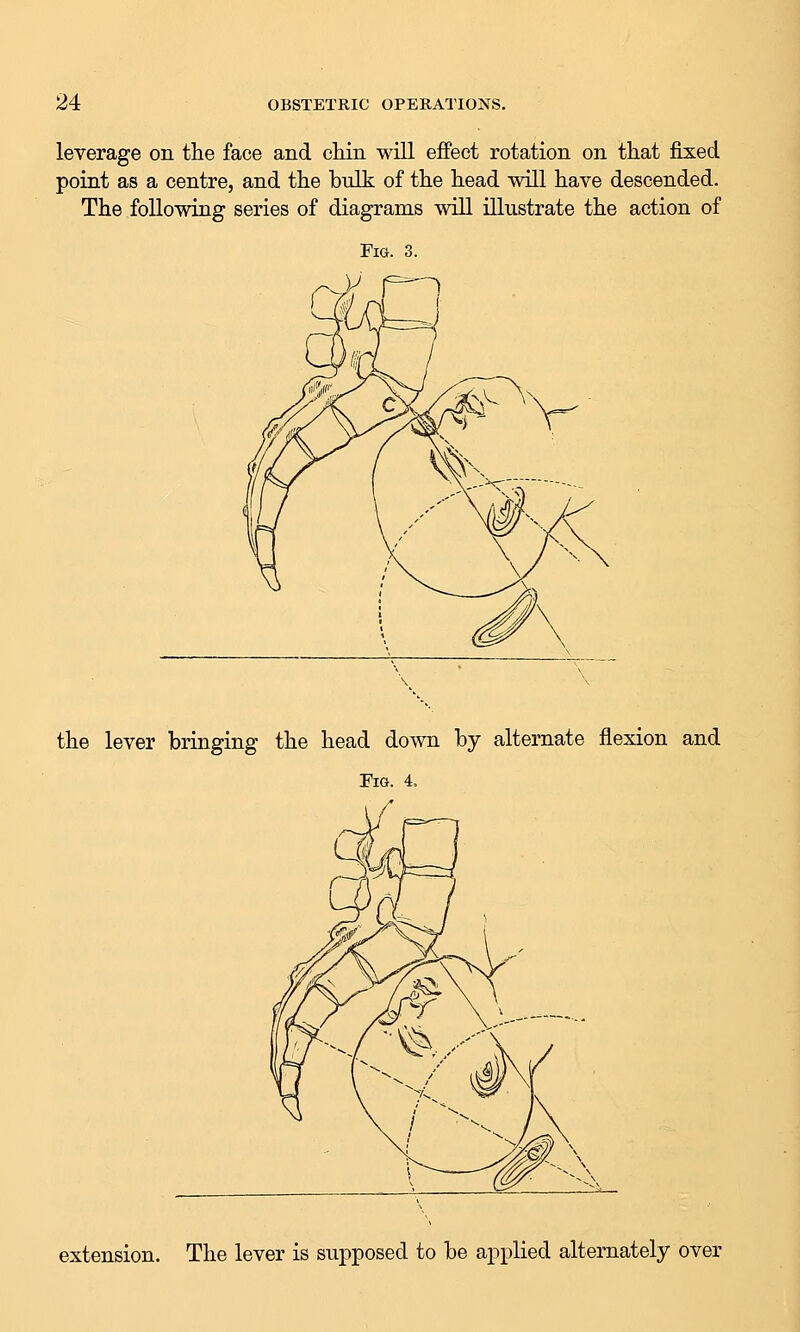 leverage on the face and chin will eifect rotation on that fixed point as a centre, and the bulk of the head will have descended. The following series of diagrams will illustrate the action of Fig. 3. the lever bringing the head down by alternate flexion and Fm. 4. extension. The lever is supposed to be applied alternately over