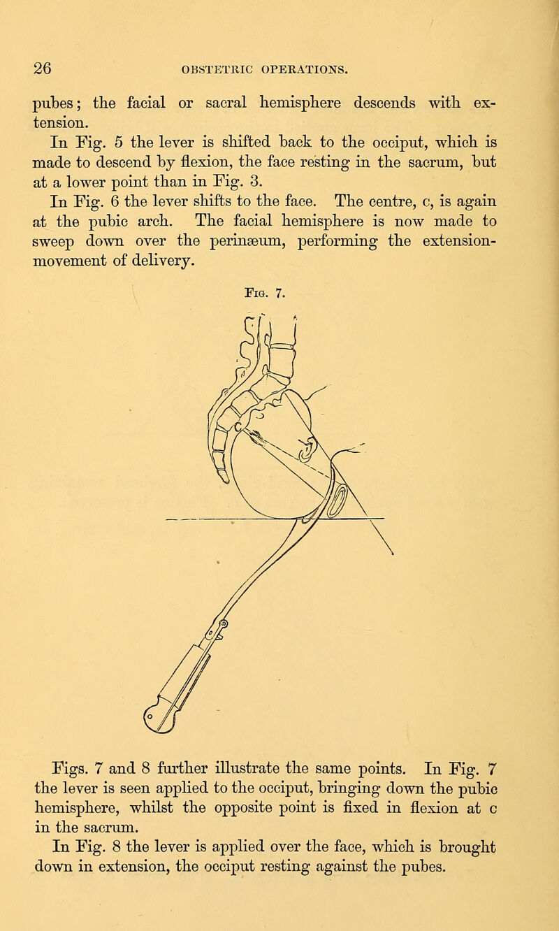 pubes; the facial or sacral hemisphere descends with ex- tension. In Fig. 5 the lever is shifted hack to the occiput, which is made to descend by flexion, the face resting in the sacrum, but at a lower point than in Fig. 3. In Fig. 6 the lever shifts to the face. The centre, c, is again at the pubic arch. The facial hemisphere is now made to sweep down over the perinseum, performing the extension- movement of delivery. \ Fig. 7. Figs. 7 and 8 further illustrate the same points. In Fig. 7 the lever is seen applied to the occiput, bringing down the pubic hemisphere, whilst the opposite point is fixed in flexion at c in the sacrum. In Fig. 8 the lever is applied over the face, which is brought down in extension, the occiput resting against the pubes.