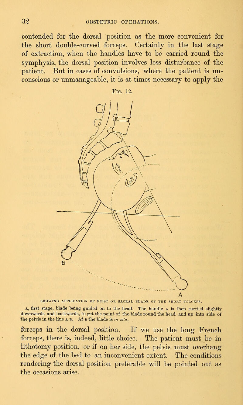 contended for the dorsal position as tlie more convenient for the short double-curved forceps. Certainly in the last stage of extraction, when the handles have to be carried round the symphysis, the dorsal position involves less disturbance of the patient. But in cases of convulsions, where the patient is un- conscious or unmanageable, it is at times necessary to apply the Fig. 12. SHOWING APPLICATION OP FIRST OR SACRAL BLADE OF THE SHORT FOIiCEPR. A, first stage, blade being guided on to the head. The handle a is then carried slightly downwards and backwards, to get the poiat of the blade round the head and up into side of the pelvis iu the line a b. At b the blade is in situ. forceps in the dorsal position. If we use the long French forceps, there is, indeed, little choice. The patient must be in lithotomy position, or if on her side, the pelvis must overhang the edge of the bed to an inconvenient extent. The conditions rendering the dorsal position preferable will be pointed out as the occasions arise.