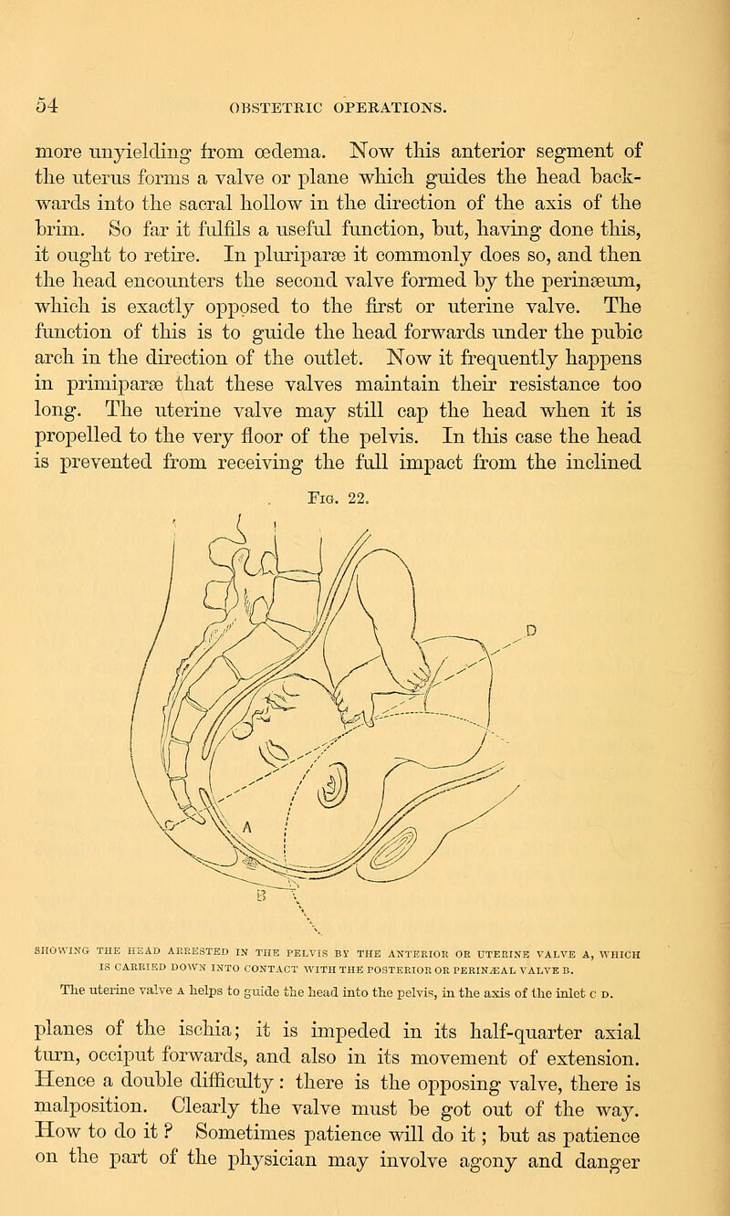 more unyielding from oedema. Now this anterior segment of tlie uterus forms a valve or plane wMcli guides tlie liead back- wards into tlie sacral hollow in the direction of the axis of the brim. So far it fulfils a useful function, but, having done this, it ought to retire. In pluriparse it commonly does so, and then the head encounters the second valve formed by the perineeum, which is exactly opposed to the first or uterine valve. The function of this is to guide the head forwards under the pubic arch in the direction of the outlet. Now it frequently happens in primiparse that these valves maintain their resistance too long. The uterine valve may still cap the head when it is propelled to the very floor of the pelvis. In this case the head is prevented from receiving the full impact from the inclined Fig. 22. SHOWING THE HEAD ABRESTED IN THE PELVIS BS THE ANTERIOR OR UTERINE VALVE A, WHICH IS CARRIED DOWN INTO CONTACT WITH THE POSTERIOR OR PERINEAL VALVE B. The uterine valve a helps to guide the head into the pelvis, in the axis of the inlet c d. planes of the ischia; it is impeded in its half-quarter axial turn, occiput forwards, and also in its movement of extension. Hence a double difficulty: there is the opposing valve, there is malposition. Clearly the valve must be got out of the way. How to do it ? Sometimes patience will do it; but as patience on the part of the physician may involve agony and danger