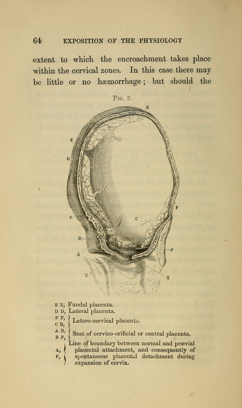 extent to which the encroachment takes place within the cervical zones. In this case there may be little or no haemorrhage; but should the Fig. 3. E E, Fundal placenta D D, Lateral placenta F F c B. Latero-cervical placenta. ' [ Seat of cervico-orificial or central placenta. Line of boundary between normal and praevial \ ±juie 01 uuuuuitry ueuweeii iiurmai <tuu pict!Via,i A, r placental attachment, and consequently of spontaneous placem expansion of cervix. f, i spontaneous placental detachment during