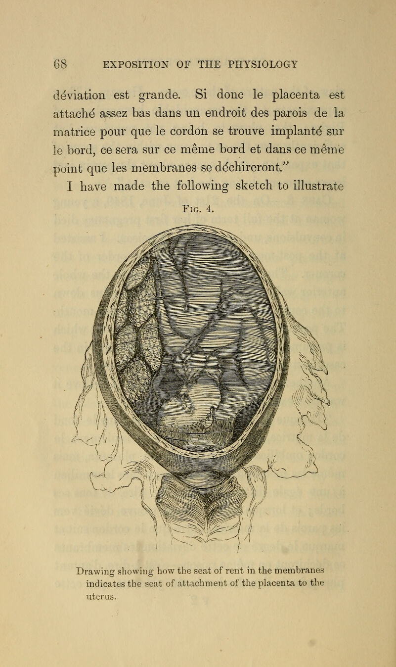 deviation est grande. Si done le placenta est attache assez bas dans un endroit des parois de la matrice pour que le cordon se trouve implante' sur le bord, ce sera sur ce meme bord et dans ce meme point que les membranes se dechireront. I have made the following sketch to illustrate Fig. 4. Drawing showing how the seat of rent in the membranes indicates the seat of attachment of the placenta to the uterus.