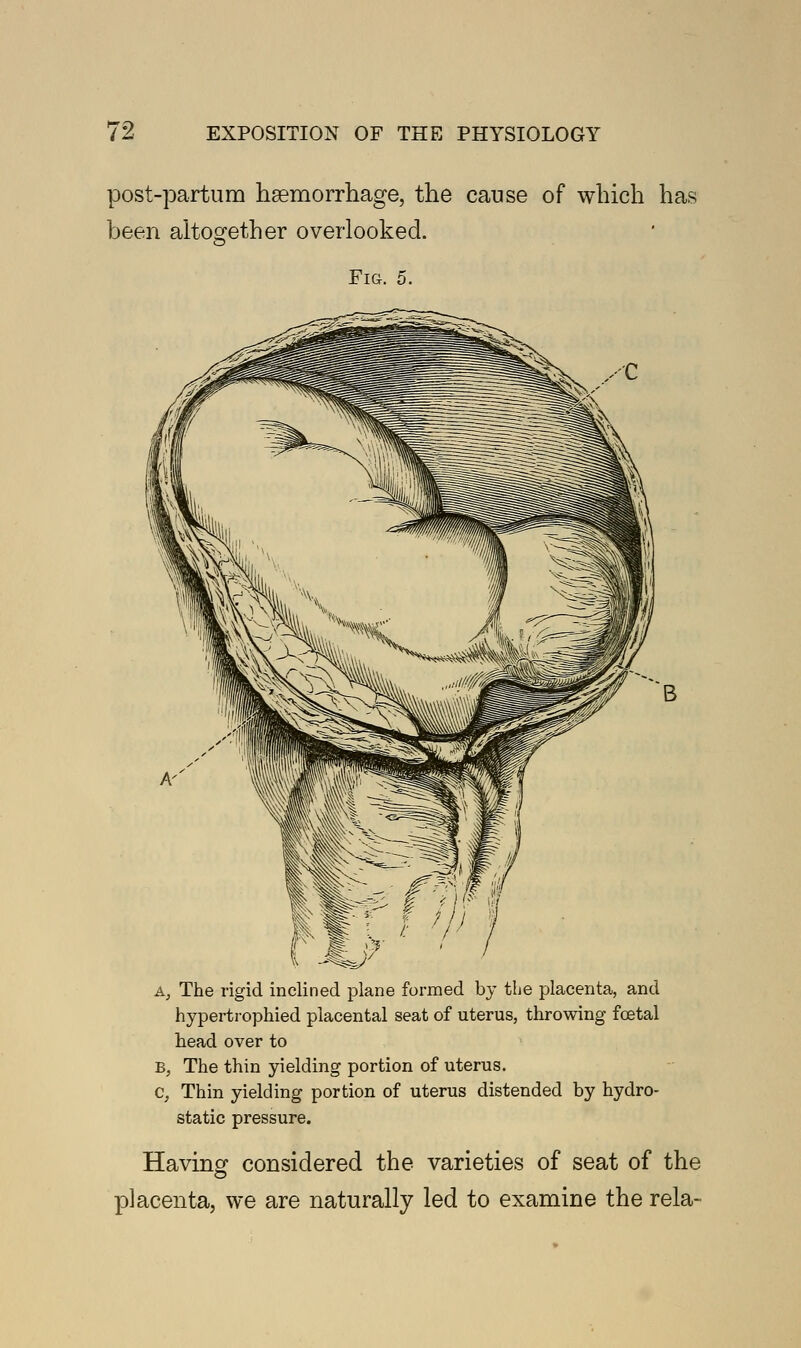 post-partum haemorrhage, the cause of which has been altogether overlooked. Fig. 5. A, The rigid inclined plane formed by the placenta, and hypertrophied placental seat of uterus, throwing foetal head over to B, The thin yielding portion of uterus. c, Thin yielding portion of uterus distended by hydro- static pressure. Having considered the varieties of seat of the placenta, we are naturally led to examine the rela-