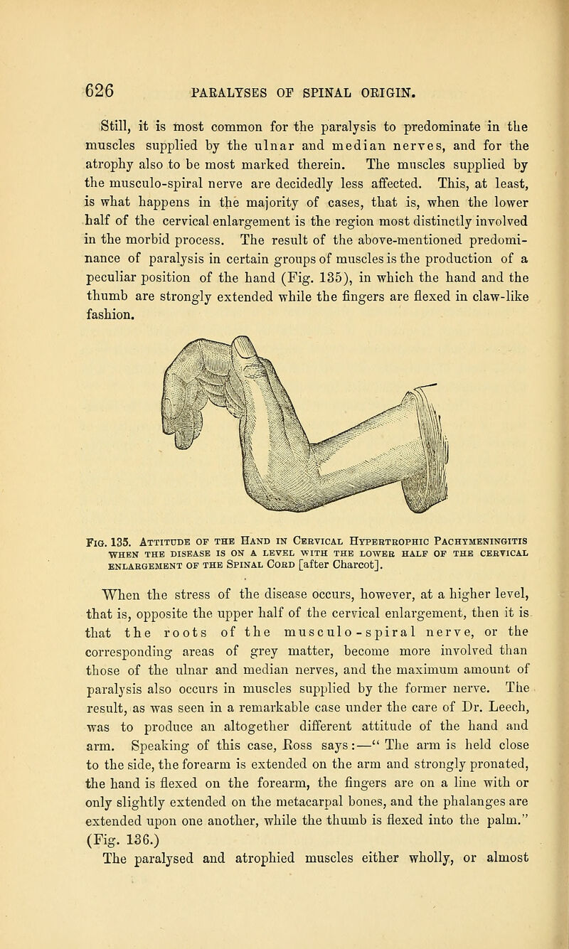 Still, it is most common for the paralysis to predominate in the muscles supplied by the ulnar and median nerves, and for the atrophy also to be most marked therein. The muscles supplied by the musculo-spiral nerve are decidedly less affected. This, at least, is what happens in the majority of cases, that is, when the lower half of the cervical enlargement is the region most distinctly involved in the morbid process. The result of the above-mentioned predomi- nance of paralysis in certain groups of muscles is the production of a peculiar position of the hand (Fig. 135), in which the hand and the thumb are strongly extended while the fingers are flexed in claw-like fashion. Fig. 135. Attitude of the Hand in Cbbvical Htpbetrophic Pachymeningitis when the disease is on a level with the loweb half of the ceetical ENLARGEMENT OF THE Spinal Cobd [after Charcot]. When the stress of the disease occurs, however, at a higher level, that is, opposite the upper half of the cervical enlargement, then it is that the roots of the musculo-spiral nerve, or the corresponding areas of grey matter, become more involved than those of the ulnar and median nerves, and the maximum amount of paralysis also occurs in muscles supplied by the former nerve. The result, as was seen in a remarkable case under the care of Dr. Leech, was to produce an altogether different attitude of the hand and arm. Speaking of this case, Ross says:— The arm is held close to the side, the forearm is extended on the arm and strongly pronated, the hand is flexed on the forearm, the fingers are on a line with or only slightly extended on the metacarpal bones, and the phalanges are extended upon one another, while the thumb is flexed into the palm. (Fig. 136.) The paralysed and atrophied muscles either wholly, or almost