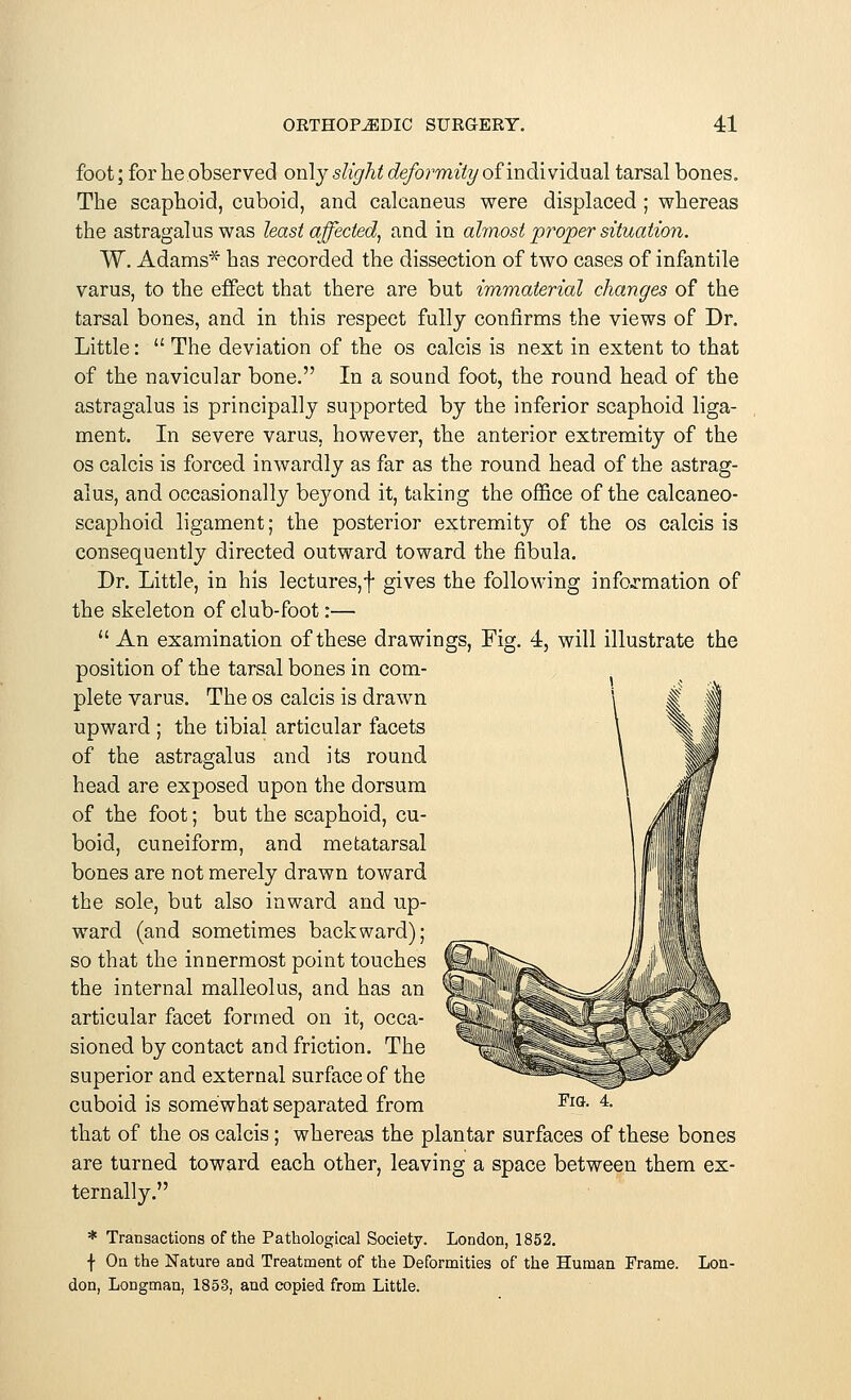 foot; for he observed only slight deformity of individual tarsal bones. The scaphoid, cuboid, and calcaneus were displaced ; whereas the astragalus was least affected, and in almost proper situation. W. Adams* has recorded the dissection of two cases of infantile varus, to the effect that there are but immaterial changes of the tarsal bones, and in this respect fully confirms the views of Dr. Little:  The deviation of the os calcis is next in extent to that of the navicular bone. In a sound foot, the round head of the astragalus is principally supported by the inferior scaphoid liga- ment. In severe varus, however, the anterior extremity of the os calcis is forced inwardly as far as the round head of the astrag- alus, and occasionally bej^ond it, taking the office of the calcaneo- scaphoid ligament; the posterior extremity of the os calcis is consequently directed outward toward the fibula. Dr. Little, in his lectures,f gives the following information of the skeleton of club-foot:—  An examination of these drawings, Fig. 4, will illustrate the position of the tarsal bones in com- plete varus. The os calcis is drawn upward ; the tibial articular facets of the astragalus and its round head are exposed upon the dorsum of the foot; but the scaphoid, cu- boid, cuneiform, and metatarsal bones are not merely drawn toward the sole, but also inward and up- ward (and sometimes backward); so that the innermost point touches the internal malleolus, and has an articular facet formed on it, occa- sioned by contact and friction. The superior and external surface of the cuboid is somewhat separated from that of the os calcis; whereas the plantar surfaces of these bones are turned toward each other, leaving a space between them ex- ternally. * Transactions of the Pathological Society. London, 1852. \ On the Nature and Treatment of the Deformities of the Human Frame. Lon- don, Longman, 1853, aud copied from Little. Fig. 4.