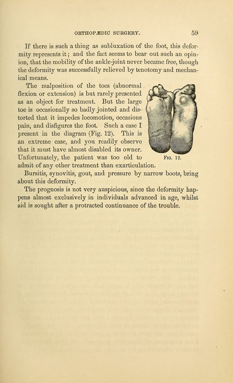 If there is such a thing as subluxation of the foot, this defor- mity represents it; and the fact seems to bear out such an opin- ion, that the mobility of the ankle-joint never became free, though the deformity was successfully relieved by tenotomy and mechan- ical means. The malposition of the toes (abnormal flexion or extension) is but rarely presented as an object for treatment. But the large toe is occasionally so badly jointed and dis- torted that it impedes locomotion, occasions pain, and disfigures the foot. Such a case I present in the diagram (Fig. 12). This is an extreme case, and you readily observe that it must have almost disabled its owner. admit of any other treatment than exarticulation. Bursitis, synovitis, gout, and pressure by narrow boots, bring about this deformity. The prognosis is not very auspicious, since the deformity hap- pens almost exclusively in individuals advanced in age, whilst aid is sought after a protracted continuance of the trouble.