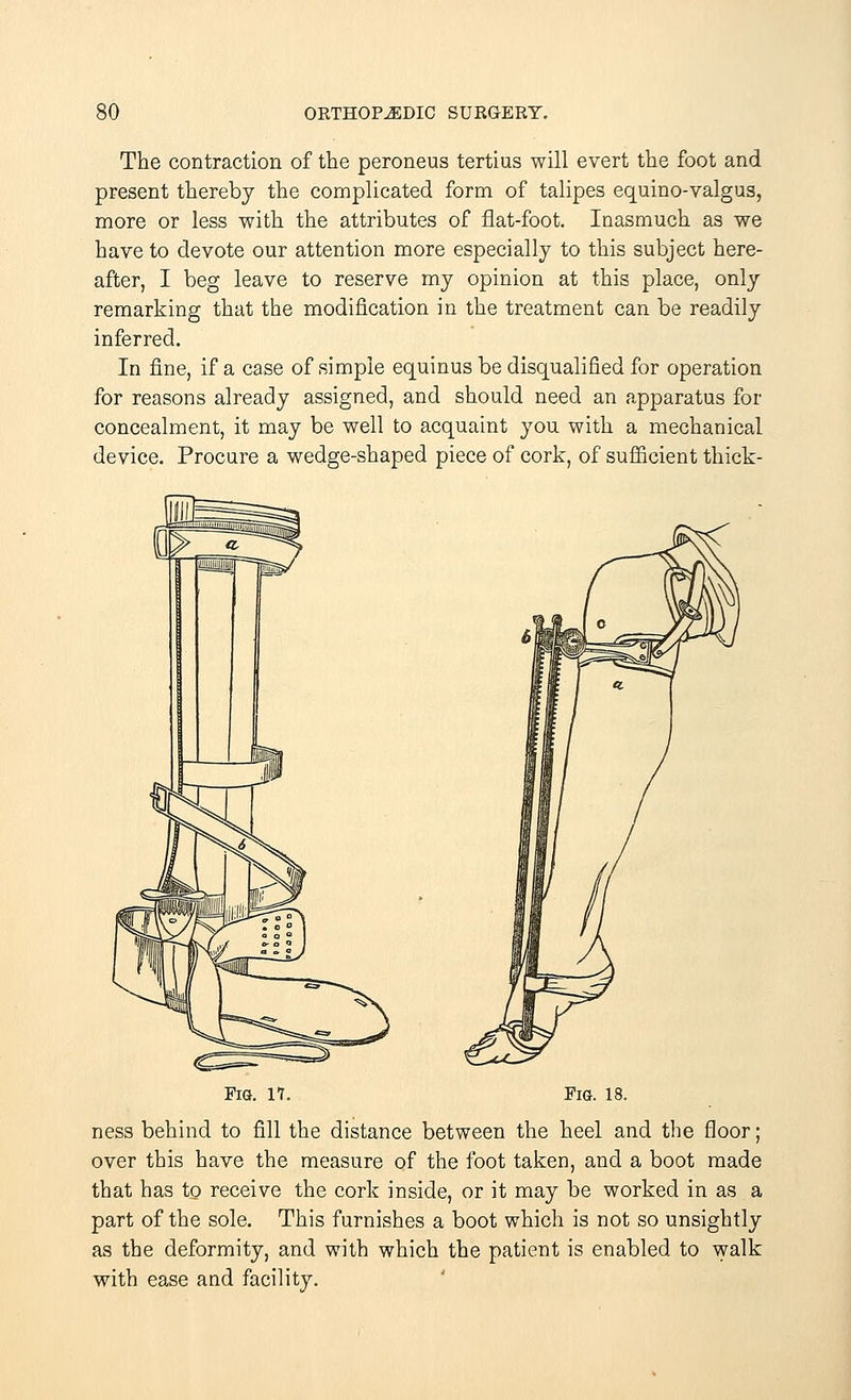 The contraction of the peroneus tertius will evert the foot and present thereby the complicated form of talipes equino-valgus, more or less with the attributes of flat-foot. Inasmuch as we have to devote our attention more especially to this subject here- after, I beg leave to reserve my opinion at this place, only remarking that the modification in the treatment can be readily inferred. In fine, if a case of simple equinus be disqualified for operation for reasons already assigned, and should need an apparatus for concealment, it may be well to acquaint you with a mechanical device. Procure a wedge-shaped piece of cork, of sufficient thick- Fig. 17. Fig. 18. ness behind to fill the distance between the heel and the floor; over this have the measure of the foot taken, and a boot made that has to receive the cork inside, or it may be worked in as a part of the sole. This furnishes a boot which is not so unsightly as the deformity, and with which the patient is enabled to walk with ease and facility.