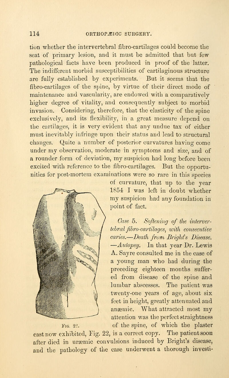 tion whether the intervertebral fibro-cartilages could become the seat of primary lesion, and it must be admitted that but few pathological facts have been produced in proof of the latter. The indifferent morbid susceptibilities of cartilaginous structure are fully established by experiments. But it seems that the fibro-cartilages of the spine, by virtue of their direct mode of maintenance and vascularity, are endowed with a comparatively higher degree of vitality, and consequently subject to morbid invasion. Considering, therefore, that the elasticity of the spine exclusively, and its flexibility, in a great measure depend on the cartilages; it is very evident that any undue tax of either must inevitably infringe upon their status and lead to structural changes. Quite a number of posterior curvatures having come under my observation, moderate in sj^mptoms and size, and of a rounder form of deviation, my suspicion had long before been excited with reference to the fibro-cartilages. But the opportu- nities for post-mortem examinations were so rare in this species of curvature, that up to the year 1854 I was left in doubt whether my suspicion had any foundation in point of fact. Case 5. Softening of the interver- tebral fibro-cartilages, with consecutive caries.—Death from Bright!s Disease. —Autopsy. In that year Dr. Lewis A. Sayre consulted me in the case of a young man who had during the preceding eighteen months suffer- ed from disease of the spine and lumbar abscesses. The patient was twenty-one years of age, about six feet in height, greatly attenuated and anaemic. What attracted most my attention was the perfect straightness cast now exhibited, Fig. 22, is a correct copy. The patient soon after died in ursemic convulsions induced by Bright's disease, and the pathology of the case underwent a thorough investi-