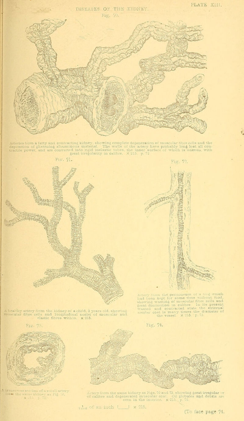 >/ )JSEA::E3 Oi^ 'TWA .KlDNE^j Arteries ivoirx a fatty and contracting kidney, sb-ovying coixip]ete deAeneratiou ot inuscular nbre cells and the deposition of A^istening albuminous mateiial. Tlie walls of the artery have probably long lost all con- tractils power, and are converted into rigid inelastic t\il:)es. the inner surface oi which is iineveu, with great irregularity in calibre. X 215. p. TO Kie\ 71. A healthy artery from the kidney of a child, 3 years old, sho\wini> muacular fibre cells aad longitudinal nuclei of muscular and elastic fibres within, x 215. 5'ig. 72. if ' II- peril .UfUm ' 1 l m ^ wxrich bad I'efiu k-pt t I some time without t&od, showing waotin,^ ot mnsoul u fibre cells and great diuiiijution m c ilibie In its present ■lasted and contidcted start- tbp external areolar coat is mauy times the diameter of the vessel X -15. ' p- ^o. Jig. 74. 'tv^ /^ ^itei V ti om the same kidnry as i'lgs 70 and 73 showing great irregular i if calibre and d=geneiated mnsoiilar coar Oil globules arid debris a: seen m the mieiioi. x -10. _ p. 72. if ail iiich J X 215.