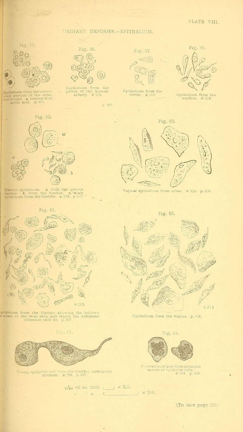 TRINARY DBPOSIT-S.—EPITHELIUM. PLATE VIll. yOo [X®] ip^ Bpltbelium irom the convo- iur^d portion of the urini- hei-ous tu.be. a. treated with 1 acetic acid, x 31-^. Fig. 56. Epithelium from tbe pelvis of the human kidney. X 215. Fig. 57. Epithelium from the ureter, x -15. Fig. .53. Fig, 59. .&^^ ®^f ^W Bladder epithelium. a. frota -tlj* general surface 6. from the fundus. c.'scaly epiLhelium from the bladder, x 215. p. 3j7. Fig. 60. Vaginal epithelium from urine. X 215. p. 328, ^ & N >< ipithelium. frotn the bladder, showing the hollows u some of the large cells into which the subjacent columnar cells fit. p. 327. Fig. 62. Hr-^- ''- - 1 » \ '^ l^r Epithelium from the vagina, p. Fi^-. C3. uu epiihflial ct-il icm the bladder, undergoing aivision. X 700. p. 327. Fig. 64. F ji mation ot pus flora germinal mattPi of pfitb'=lial cells X 215 p 3-8 of all inch X 31o. X 700.