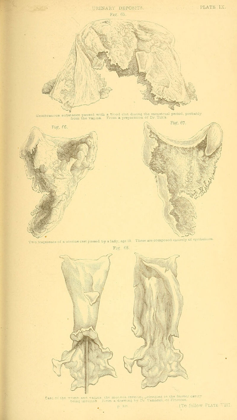 PLATii  IX. -:?^ Membranous substance passed w)tb a blood clot during tbe menstrua.1 period, probably from tbe -srag.na. From a preparation of Dr. Tilt s. '^r 1^ msiK \ 1' \ .4 Two fragments of a uterine cast passed by a lady, age 25. These are composed ouuuely ot epitbeliu Fisj. 68. 1 ^ Nil 'T^'r-^ r ^^ rasr f the -.vomb and rasina. the mucous corerio:^ oi?lon4in5 to the former caTitr being mverted. From a drawing by Dr Vannoru. <ot IJorcnce. P 3,i-- [To follow Plate 'HI