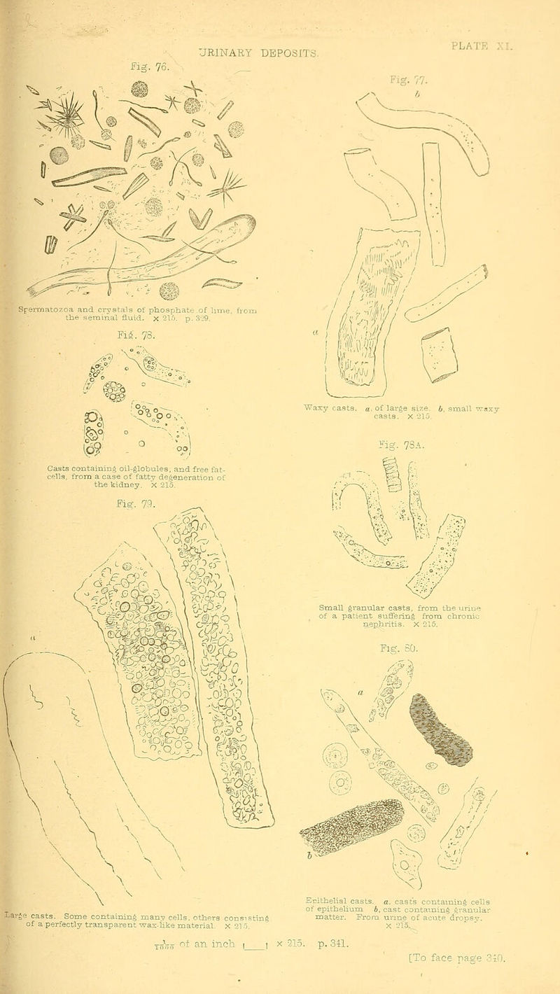 PLATE J^ig. 76. Spermatozoa and crystals of phosphate of lime, from the semiiial fluid, x 21;'). p. 3-:9. FiS. 78. .ffjjs ° O o ^■•, m Casts containing oil-globules, and free fat- cells, from a case of fatty degeneration of the kidney, x 21.5. Fi^. 73. .ItN °W}§o% Lai-^e casts. Some containing many cells, others consistini; of a perfectly transparent wax-like material. X 215. Small ^ranijlar casts, from the urio*^ of a patient suffering from chronic ne-phritis. X 215. Pig bO Epithelial casts, a. cast's containing cells of epithehum b, cast coutaining granular matter. From urine of acute drocsv. X 215, *  Yj^^n of an iTich i i x SIS. p. 341.