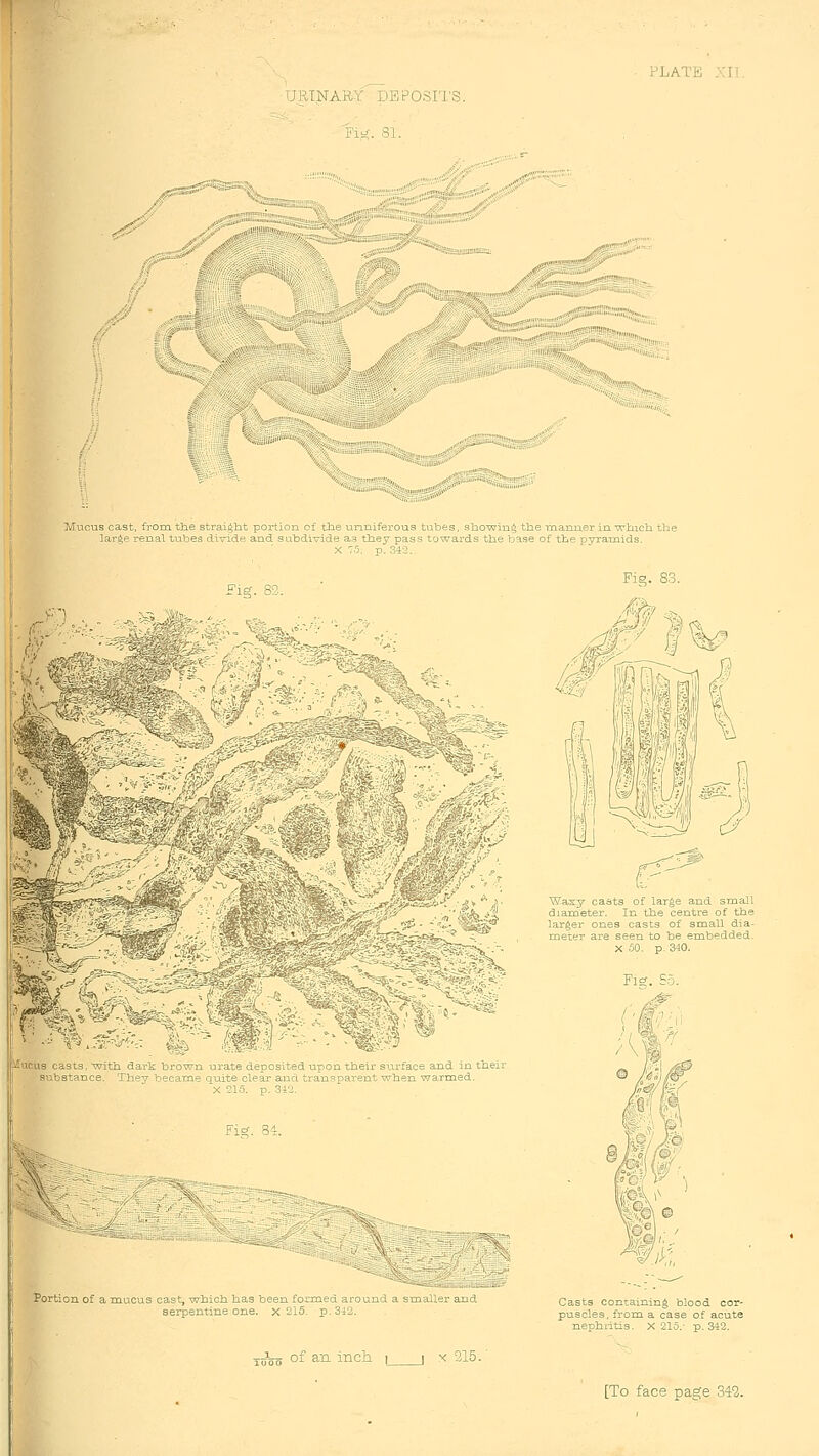 -URTNAaY DBPOSri'S. FiK. 81. ^'- „rf*i'nw*^<,i.c- Mucus cast, from the straight portion of the unniferous tubes, sho-wing the raanuer in which the large renal tubes divide and subdivide as they pass towards the base of the pyramids. X 75. p. 34-2. Fig. 89.. ii 1CU8 casts With darL brown urate depos ted upon xheir s face and n the substance Th-^-y h pcame j_tite clear anc an'^parent when warmed X 15 p 3i Portion of a mucus cast, which has been formed ar serpentine one. x 215. p. 342 YuVo of an inch l X 215/ larger ones casts of small dia- meter are seen to be embedded. X 50. p. 340. Casts containing blood cor- puscles, from a case of acute nephritis. X 215.- p. 342.