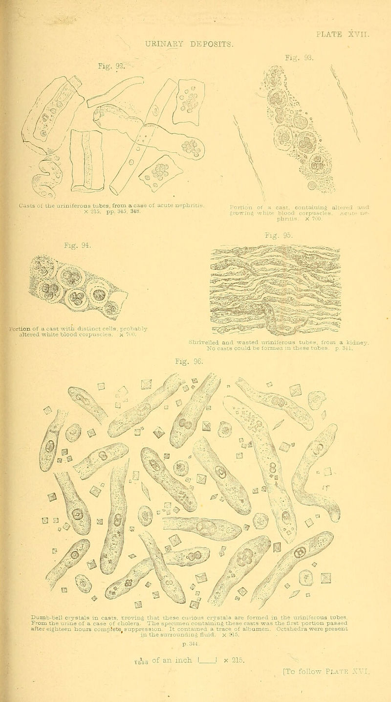 URINARY DEPOSITS. Fig. 92/ c'lists of Lbe uriniferous tubes, from a case of acute nephritis X 215. pp. 315, 318, Tig. 93. ' ••■'v^^.\ \ Jr'ortion of a cast, coutaiuing aU.cov.-cl :ind j'^i'owin^ white blooc] corpiiflCles. ,.cuii-' vxf- pbntis. X 700. Fig. 94. &^ rtion of a cast with distinct cells, probably altered white blood coipuscles. x 7tiO. ^T^s^^?' Fig. 95. ,^2r Shrivelled and. wasted unnifeious t-Lbc^ t om a kidnej Iso cAbts could be tDrraea n tla set bcs p 311. Fig. 96. Dumb-bell crystals in casts, rroving that tbese cuiious crystals are formed in tbe uiiniferous tubes. Frora tbe urine of a case of cliolera. Tbe speciixiea coutaining tbese casts was tiie first portion passed aftei-eighteen hours complete suppression. It contained a trace of albumen. Octahedra were present in the surrounding fluid, x '^IS. TcHJii ^^ ^^ inch I I X 215.