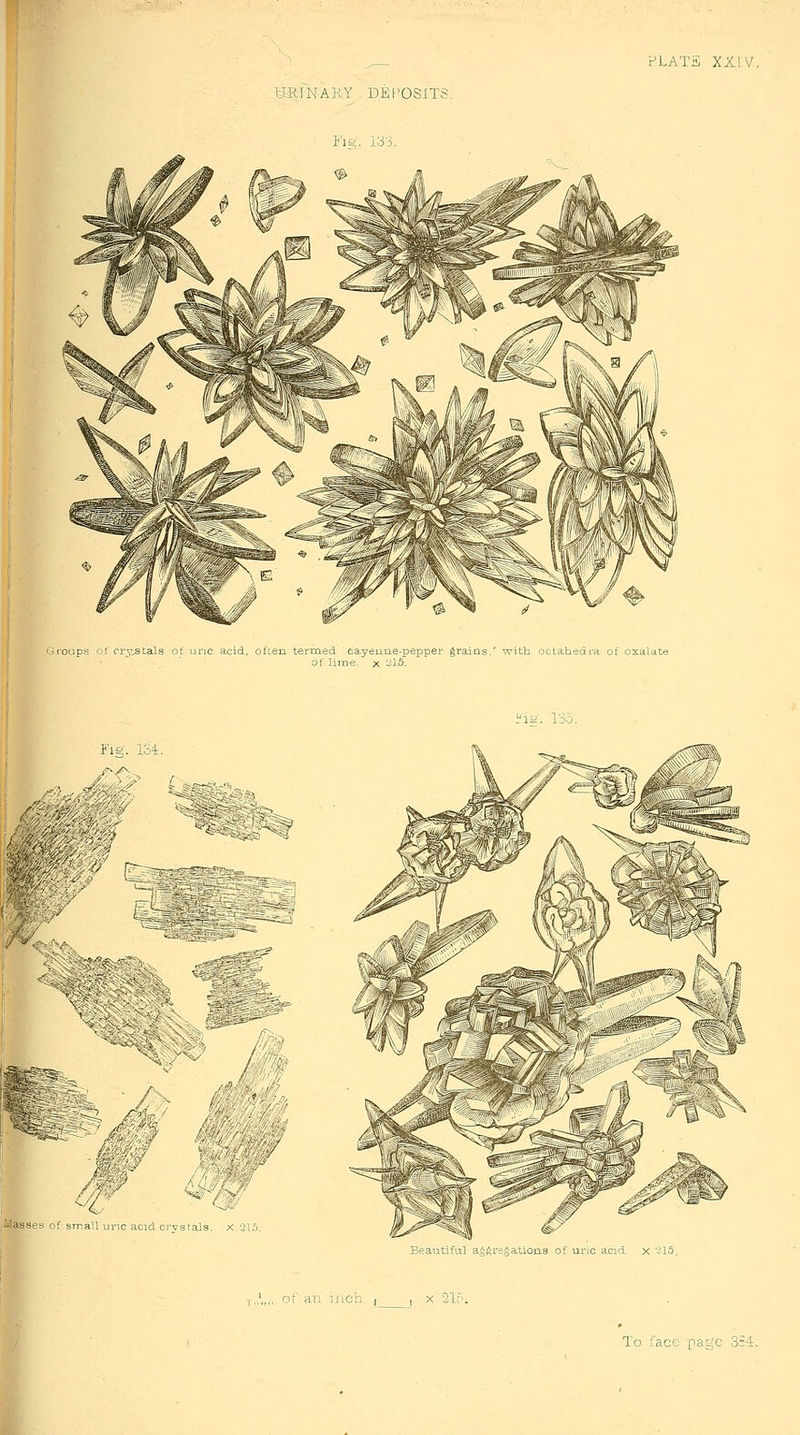 femiNAKY DEI'OSITt\ iia'. 135. Fig. 134. of srra 1 uiic acid civstals X Jl'j Beautiful agAi^-S^tions of uric acid x -15. T,,',,,, of an inch j ^| x 21o.