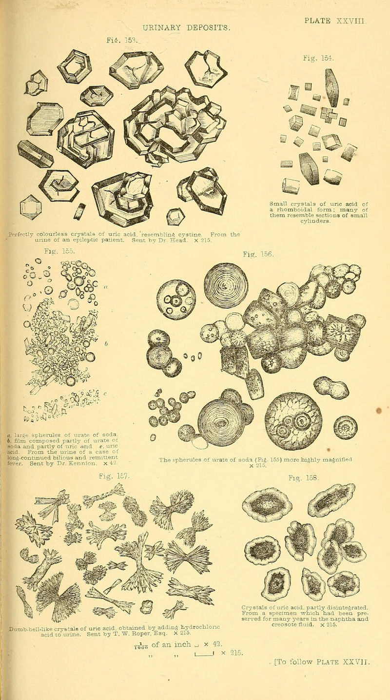 PLA.TB XXVIIl. Fi^. 154. Small cry3tal3 of uric acid of a rliomboidal form; many of them resemble sections of small cylinders. pfirfectly colourless crystals of uric acid, resembling cystine. From the urine of an epileptic patient. Sent by Dr. Head. X 21.5. FiE(. 156. 1. sol i ^i a --■'-'■ ^ II. lar^e spherules of urate of soda. 6, film composed partly of urate ot soda and partly of uric acid c, uric acid. Frora the urine of a case of Ion6-continued bilious and remittent fever. Sent by Dr. Kennion. X 4-2. Fig. 1£7. The spherules of i^rate of soda (Fig. 15.5) more higiily magnified X 215. Fig 158 D imb cell hke cryb^als of uno acid obtained by addmg hyarochlonc acid to urine. Sent by T. W. Boper, Esq. X 21o. ■^^■^ of an inch .^ x 43. Crystals of uric acid, partly disintegrated. From a specimen which had been pre- served for many years in the naphtha and creosote fluid, x 216. X 31E