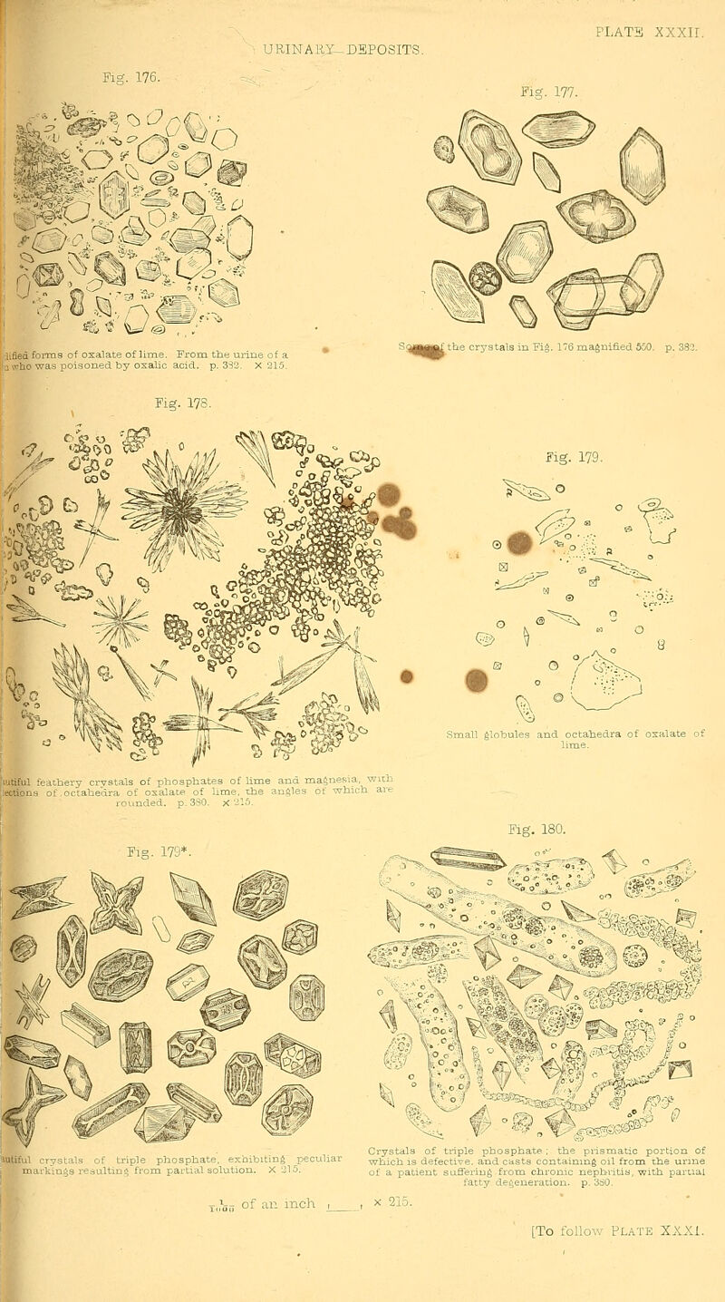 Fig. 176. Fig. 177. iified formg of oxalate of lime. From tiie urine of a Ifawtio was poisoned by osalic acid. p. 3S2. X 215. SijM^ttf the crystals in Fi*. 176 magnified 550. p. 382 Fig. 178. Fig. 179. 0| !-y (^ °r: ^ J lutiful feathery crvstals of phosphates of Ume and magnesia, with [leeiions of octahedra of oxalate of lime, the angles of wbich are i ■ rounded, p. 330. x 215. Fig. 179*. Small globules and octahedra of oxalate of lltne. Fig. 180. Crystals of triple phosphate tht^ p smatic poition of lutitul rrvstals of tuple phosphate exmbiting peculiar wh ch is defective and oasts contd n ng o 1 from the u me ■ na,ikings lesultms, fiom pattial solution. X Jl 5 Qt a_ patient buSeiiug from chiomc nepbiitis, with paitial fatty degeneration, p. 3ti0. j„'5„ of an mch , , x 215.