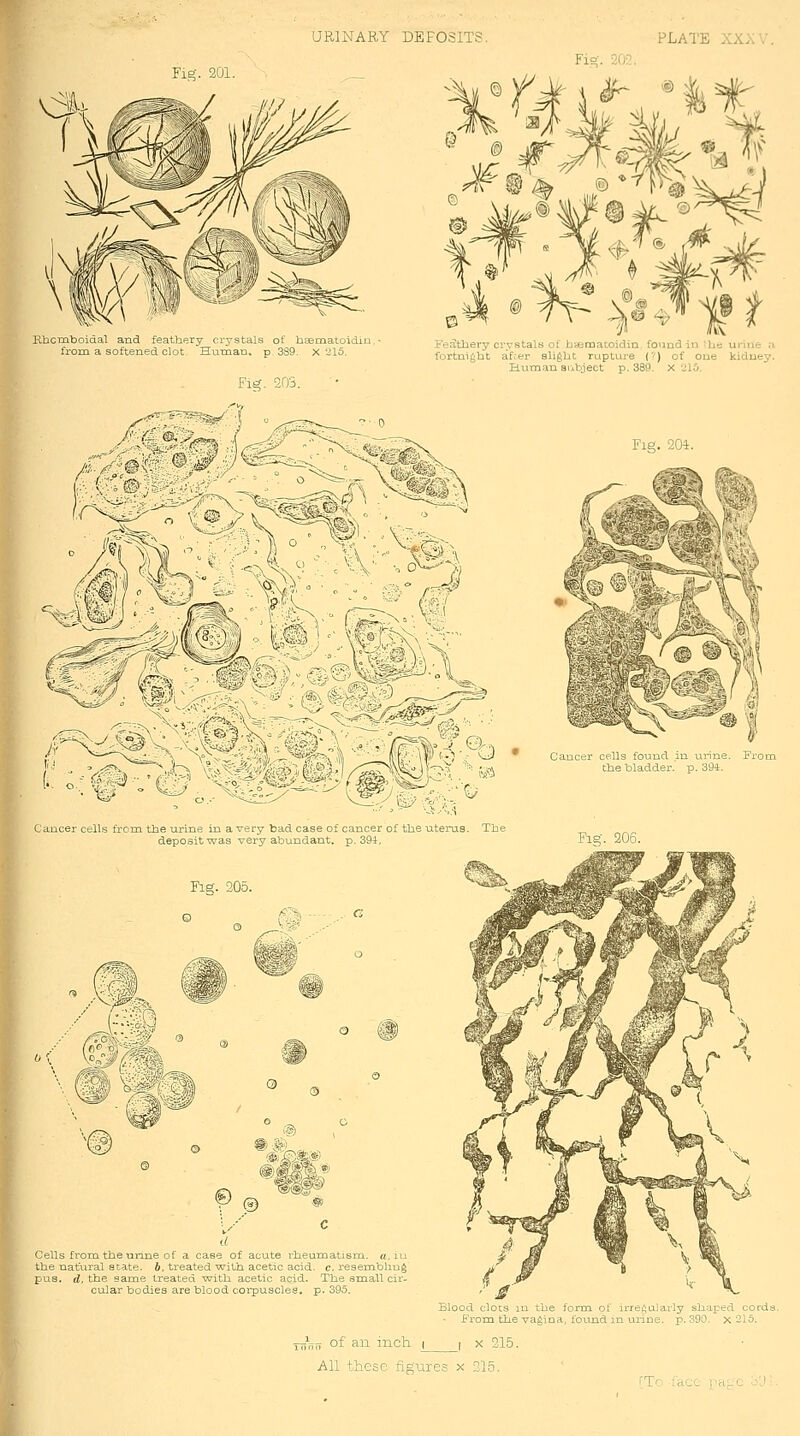 Klicmboiaal and featbpry ciystals ot bdematoidiu. from a softened clot. Human, p 3S9. X 215. Fig. 203. %»^^^t I'eatbery crystals ot b<Bmatoidin, found in ^he urine a fortnight after slight rupture (?) of one kidney. Human siibject p. 389. X 215. Fig. 204. Cancer cells ticm the urme m a veiy bad case of cancer of the uterus The depc^it ■was very abundant, p. 39i, Fig. 205. Cancer cells found in urine. Fron the bladder, p. 39i. Fig. 206. - v^. % Wi'^ ^ <5 ,®, © ® Cells from the unne of a case of acute rbeumatisra. «, iu the natural atate. h. treated ■with acetic acid. c. resembhug pas. d, the same treated with acetic acid. The small cir- cular bodies are blood corpuscles, p. 395. Blood clots lu the /orro. of irregularly shaped corda From the vagina, found in urine, p. 390. X 215. ~ru^ of a^ inch j I X 215. h\l these figures x 215. TTo iacc