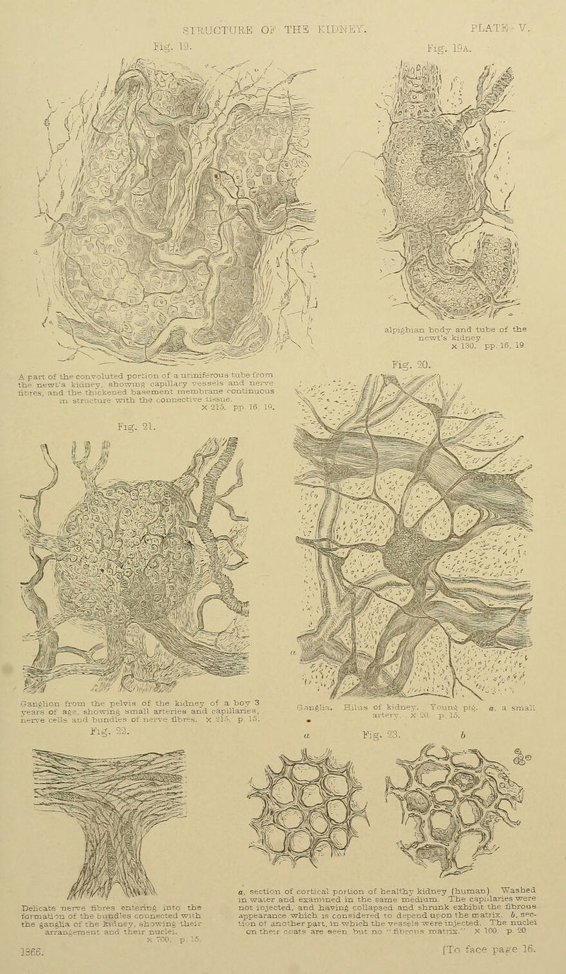 1 '■ Fig. 19a. Lv : of the convoluted pc and the thickened b i^S«s=sa?85-' Delicate nerw Bbres ^r.-ering into the formation :: the adles connected with the jan^lia c:' the .kianey, showing their arrangement and then- nuclei. - ■ a, section of cortical portion of healthy kidney (human) Washed in water and examined in the same medium. The capillaries were not injected, and Jaaving collapsed and shrunk exhibit the fibrous appearance which is considered to depend upon the matrix, b. s<=c- ■i roof another pari, in which the vessels were iniected. The nuclei on then -cats are seen but no fibrous matrix. X 100. p 20 [To face ]