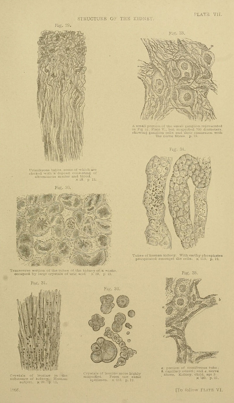 Fig. 29. $w^[ s matter and blc X 29. ioh are £1.of F 12. Fig. 30. -.-  til Crystals of leucine ■ of kidney. BUI ' ' X 20. P ?/ c >: -,' ^ &;/■  tL- ©^ igmfied. specimen. -= highly p. 13. '^i8£ i tube; i, capillary vessel; and c, nerve nbres. Kidney, child, age 3 X '00. p. 21.