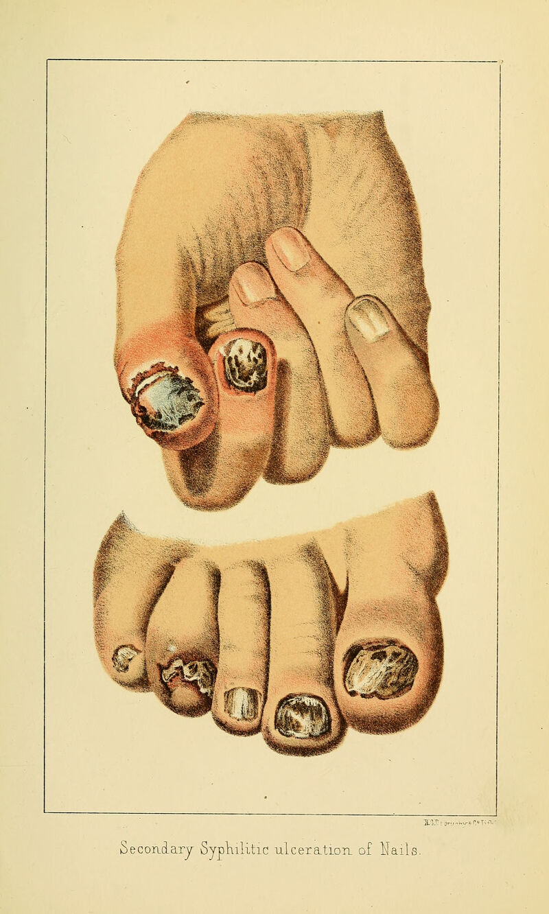 Secondary Syphilitic iilceratiori of Nails.