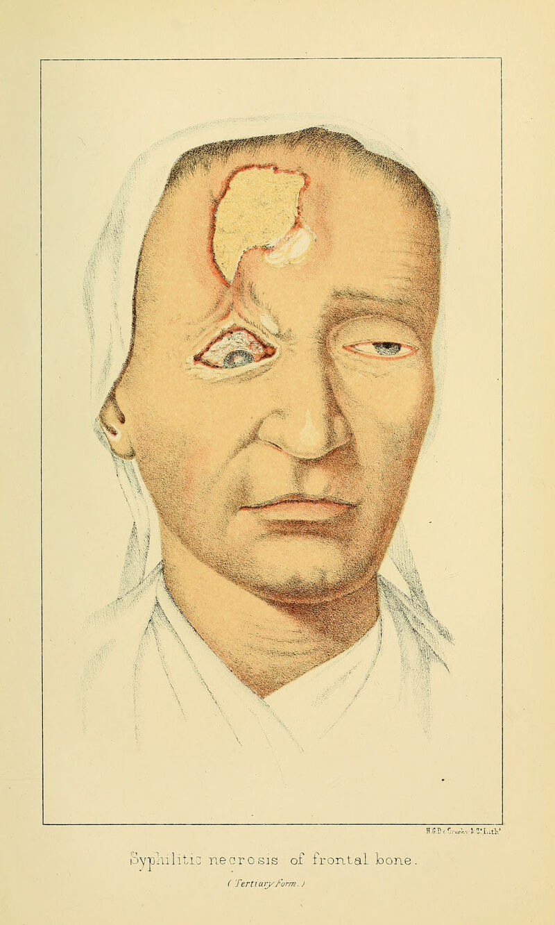 H.G2 e C™rV.v 5 3r,LitV Syphilitic necrosis of frontal bone. C 'TertiaryForm. J