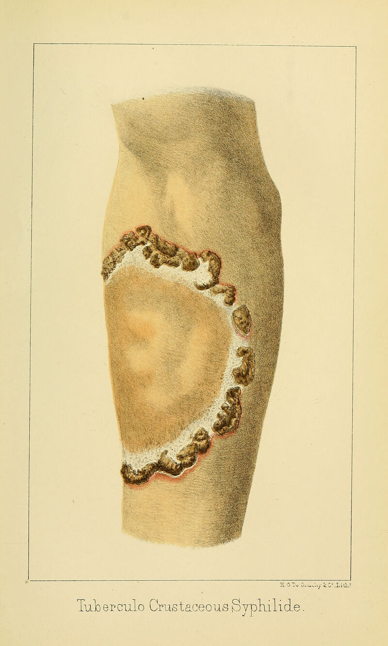 TiiJoercuIo Cmstaceous SypkilicLe