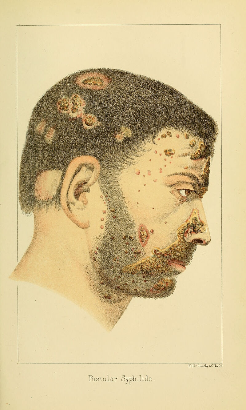 H.M'l}.-u.<iri<C'L,iK Bistulax SyphilicLe