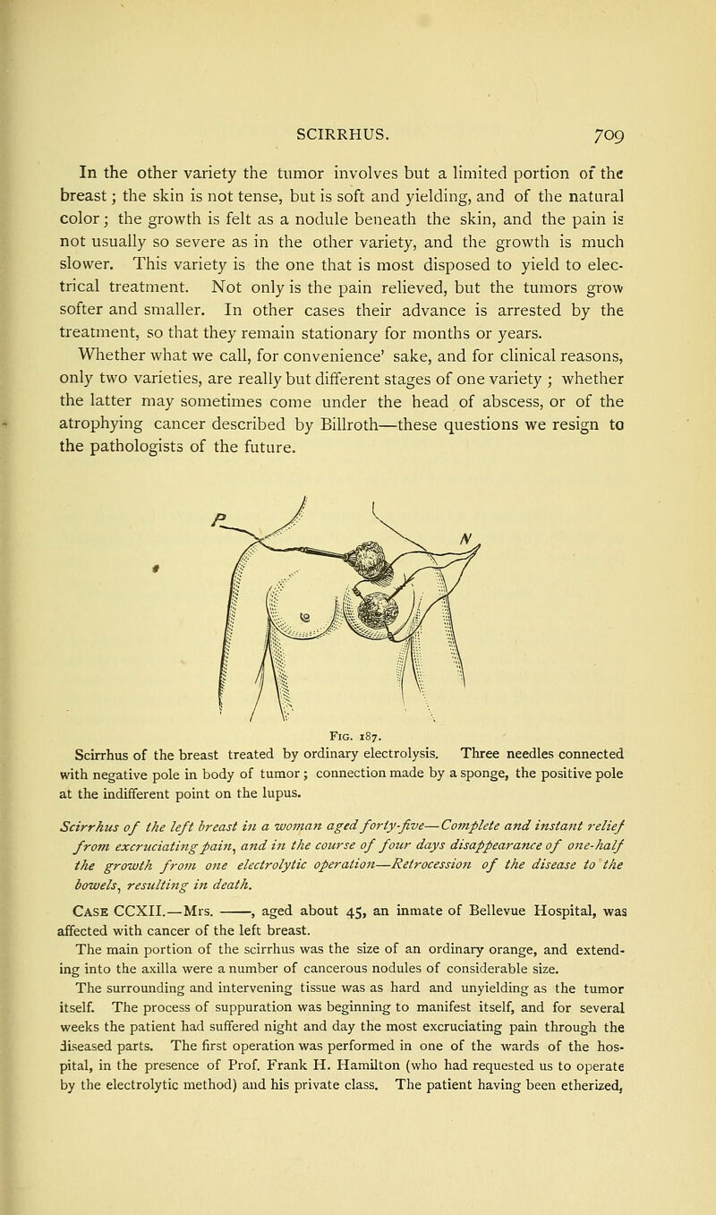 In the other variety the tumor mvolves but a limited portion of the breast; the skin is not tense, but is soft and yielding, and of the natural color; the growth is felt as a nodule beneath the skin, and the pain is not usually so severe as in the other variety, and the growth is much slower. This variety is the one that is most disposed to yield to elec- trical treatment. Not only is the pain relieved, but the tumors grow softer and smaller. In other cases their advance is arrested by the treatment, so that they remain stationary for months or years. Whether what we call, for convenience' sake, and for clinical reasons, only two varieties, are really but different stages of one variety ; whether the latter may sometimes come under the head of abscess, or of the atrophying cancer described by Billroth—these questions we resign to the pathologists of the future. Fig. 187. Scirrhus of the breast treated by ordinary electrolysis. Three needles connected with negative pole in body of tumor; connection made by a sponge, the positive pole at the indifferent point on the lupus. Scirrhus of the left breast in a womait aged forty-five—Complete and instant relief from excruciatingpain^ and in the course of four days disappearance of one-half the growth from one electrolytic operation—Retrocession of the disease to the bowels^ resulting in death. Case CCXII.—Mrs. , aged about 45, an inmate of Bellevue Hospital, was affected with cancer of the left breast. The main portion of the scirrhus was the size of an ordinary orange, and extend- ing into the axilla were a number of cancerous nodules of considerable size. The surrounding and intervening tissue was as hard and unyielding as the tumor itself. The process of suppuration was beginning to manifest itself, and for several weeks the patient had suffered night and day the most excruciating pain through the diseased parts. The first operation was performed in one of the wards of the hos- pital, in the presence of Prof. Frank H. Hamilton (who had requested us to operate by the electrolytic method) and his private class. The patient having been etherized.