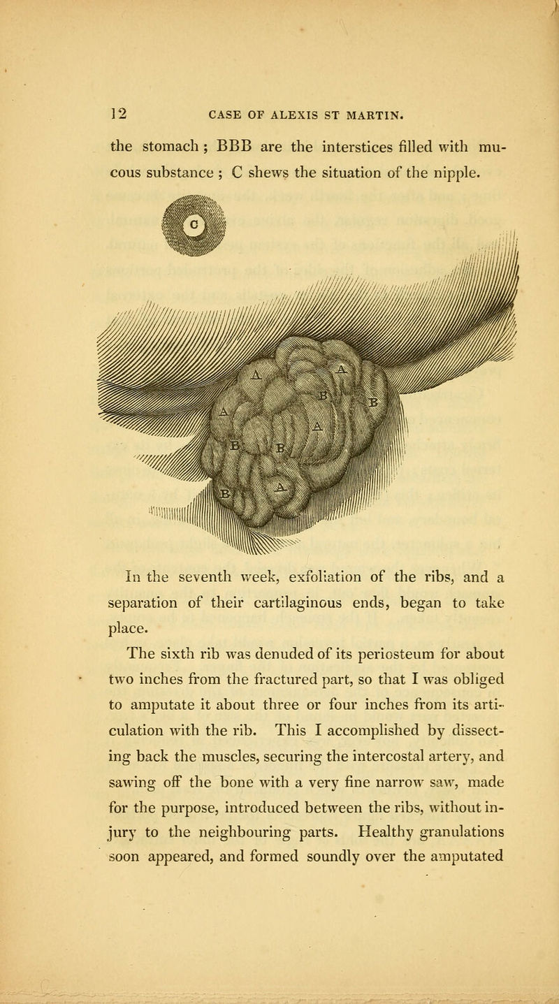 the stomach ; BBB are the interstices filled with mu- cous substance ; C shews the situation of the nipple. In the seventh week, exfoliation of the ribs, and a separation of their cartilaginous ends, began to take place. The sixth rib was denuded of its periosteum for about two inches from the fractured part, so that I was obliged to amputate it about three or four inches from its arti- culation with the rib. This I accomplished by dissect- ing back the muscles, securing the intercostal artery, and sawing off the bone with a very fine narrow saw, made for the purpose, introduced between the ribs, without in- jury to the neighbouring parts. Healthy granulations soon appeared, and formed soundly over the amputated