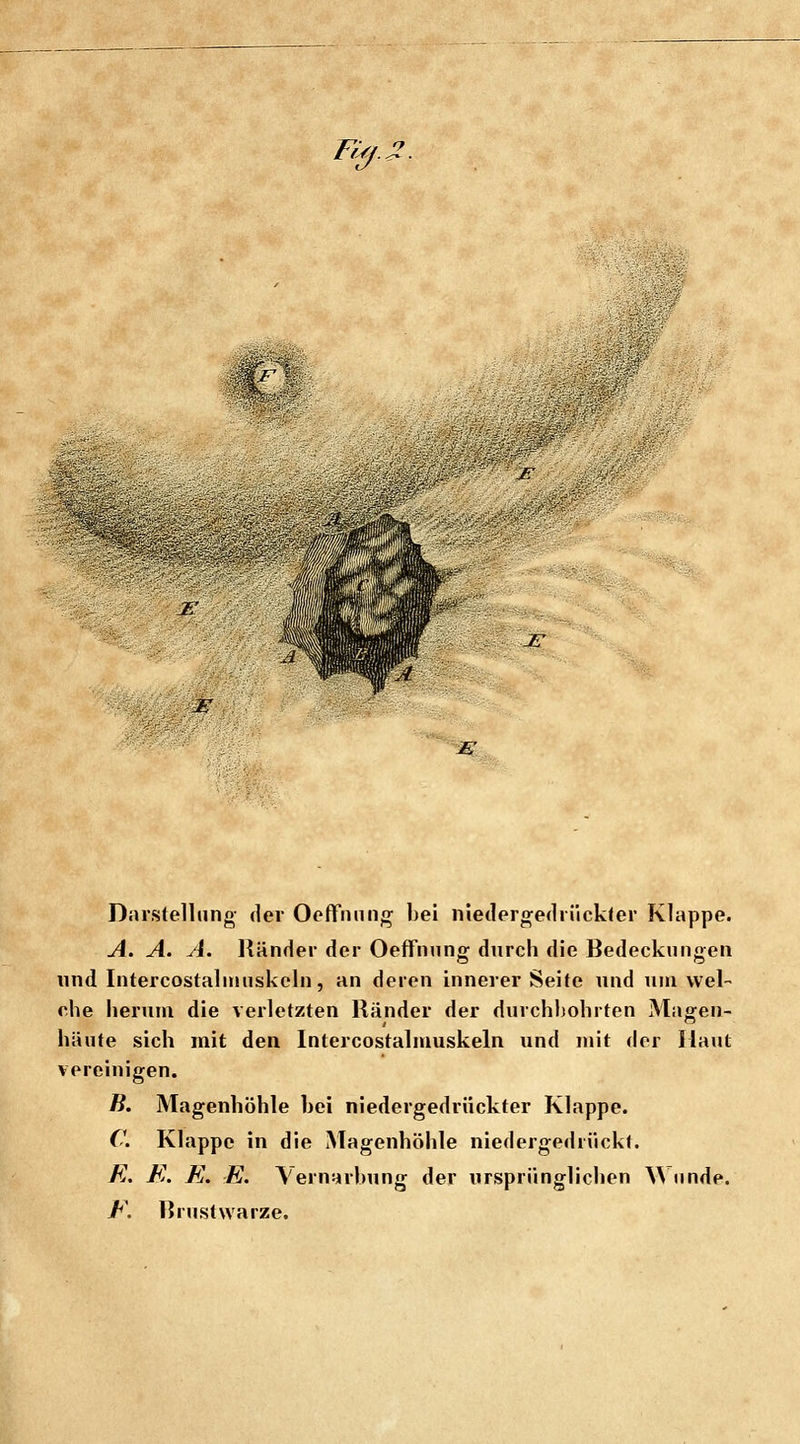 Füf. ir-t i: JET '-m^. Darstellung der Oeffniing bei niedergedrückter Klappe. A. A. A. Händer der Oeffnung durch die Bedeckungen und Intercostaliuuskeln, an deren innerer Seite und um wel- che herum die verletzten Ränder der durchbohrten Magen- häute sich mit den Intercostalmuskeln und mit der Haut vereinigen. B. Magenhöhle bei niedergedrückter Klappe. C Klappe in die Magenhöhle niedergedrückt. E. E. El. E. ^ern^rbung der ursprünglichen ^^ iinde. E\ Brustwarze.