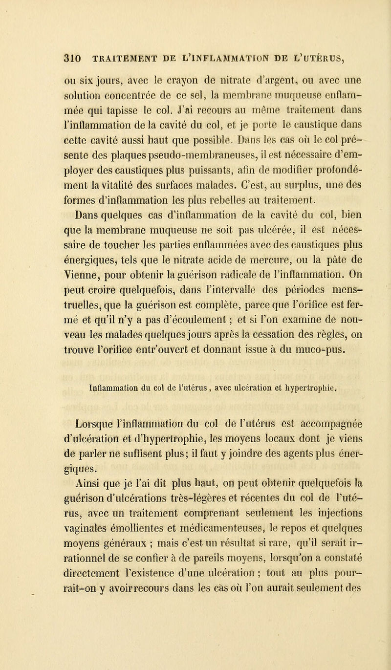 OU six jours, avec le crayon de nitrate d'argent, ou avec une solution concentrée de ce sel, la membrane muqueuse enflam- mée qui tapisse le col. J'ai recours au même traitement dans l'inllammation de la cavité du col, et je porte le caustique dans cette cavité aussi haut que possible. Dans les cas où le col pré- sente des plaques pseudo-membraneuses, il est nécessaire d'em- ployer des caustiques plus puissants, afin de modifier profondé- ment la vitalité des surfaces malades. C'est, au surplus, une des formes d'inflammation les plus rebelles au traitement. Dans quelques cas d'inflammation de la cavité du col, bien que la membrane muqueuse ne soit pas ulcérée, il est néces- saire de toucher les parties enflammées avec des caustiques plus énergiques, tels que le nitrate acide de mercure, ou la pâte de Vienne, pour obtenir laguérison radicale de l'inflammation. On peut croire quelquefois, dans l'intervalle des périodes mens- truelles, que la guérison est complète, parce que l'orifice est fer- mé et qu'il n'y a pas d'écoulement ; et si l'on examine de nou- veau les malades quelques jours après la cessation des règles, on trouve l'oritice entr'ouvert et donnant issue à du muco-pus. Inflammation du col de l'utérus , avec ulcération et hypertrophie. Lorsque l'inflammation du col de l'utérus eât accompagnée d'ulcération et d'hypertrophie, les moyens locaux dont je viens de parler ne suffisent plus; il faut y joindre des agents plus éner- giques. Ainsi que je l'ai dit plus haut, on peut obtenir quelquefois la guérison d'ulcérations très-légères et récentes du col de l'uté- rus, avec un traitement comprenant seulement les injections vaginales émollientes et médicamenteuses, le repos et quelques moyens généraux ; mais c'est un résultat si rare, qu'il serait ir- rationnel de se confier à de pareils moyens, lorsqu'on a constaté directement l'existence d'une ulcération ; tout au plus pour- rait-on y avoirrecours dans les cas où l'on aurait seulement des