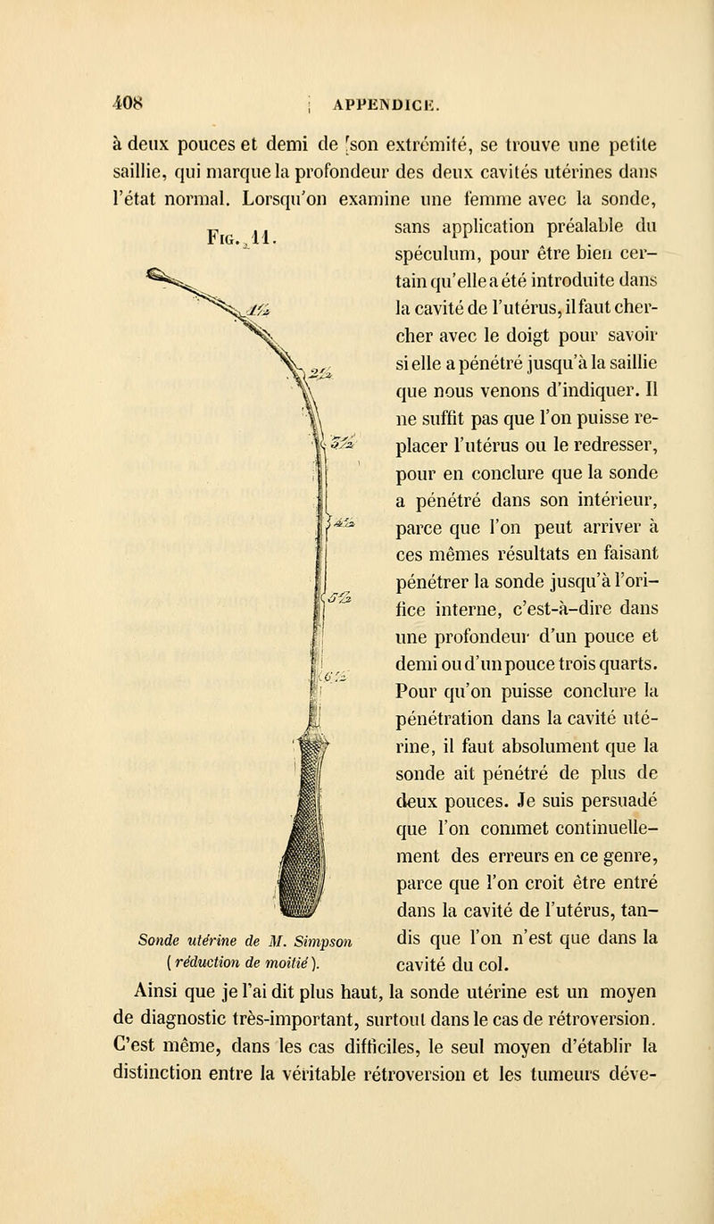 à deux pouces et demi de [son extrémité, se trouve une petite saillie, qui marque la profondeur des deux cavités utérines dans l'état normal. Lorsqu'on examine une femme avec la sonde, sans application préalable du FlG.ll. Sonde utérine de M. Simpson ( réduction de moitié ). spéculum, pour être bien cer- tain qu'elle a été introduite dans la cavité de l'utérus, il faut cher- cher avec le doigt pour savoir si elle a pénétré jusqu'à la saillie que nous venons d'indiquer. II ne suffit pas que l'on puisse re- placer l'utérus ou le redresser, pour en conclure que la sonde a pénétré dans son intérieur, parce que l'on peut arriver à ces mêmes résultats en faisant pénétrer la sonde jusqu'à l'ori- fice interne, c'est-à-dire dans une profondeur d'un pouce et demi ou d'un pouce trois quarts. Pour qu'on puisse conclure la pénétration dans la cavité uté- rine, il faut absolument que la sonde ait pénétré de plus de deux pouces. Je suis persuadé que l'on commet continuelle- ment des erreurs en ce genre, parce que l'on croit être entré dans la cavité de l'utérus, tan- dis que l'on n'est que dans la cavité du col. Ainsi que je l'ai dit plus haut, la sonde utérine est un moyen de diagnostic très-important, surtout dans le cas de rétroversion. C'est même, dans les cas difticiles, le seul moyen d'établir la distinction entre la véritable rétroversion et les tumeurs déve-