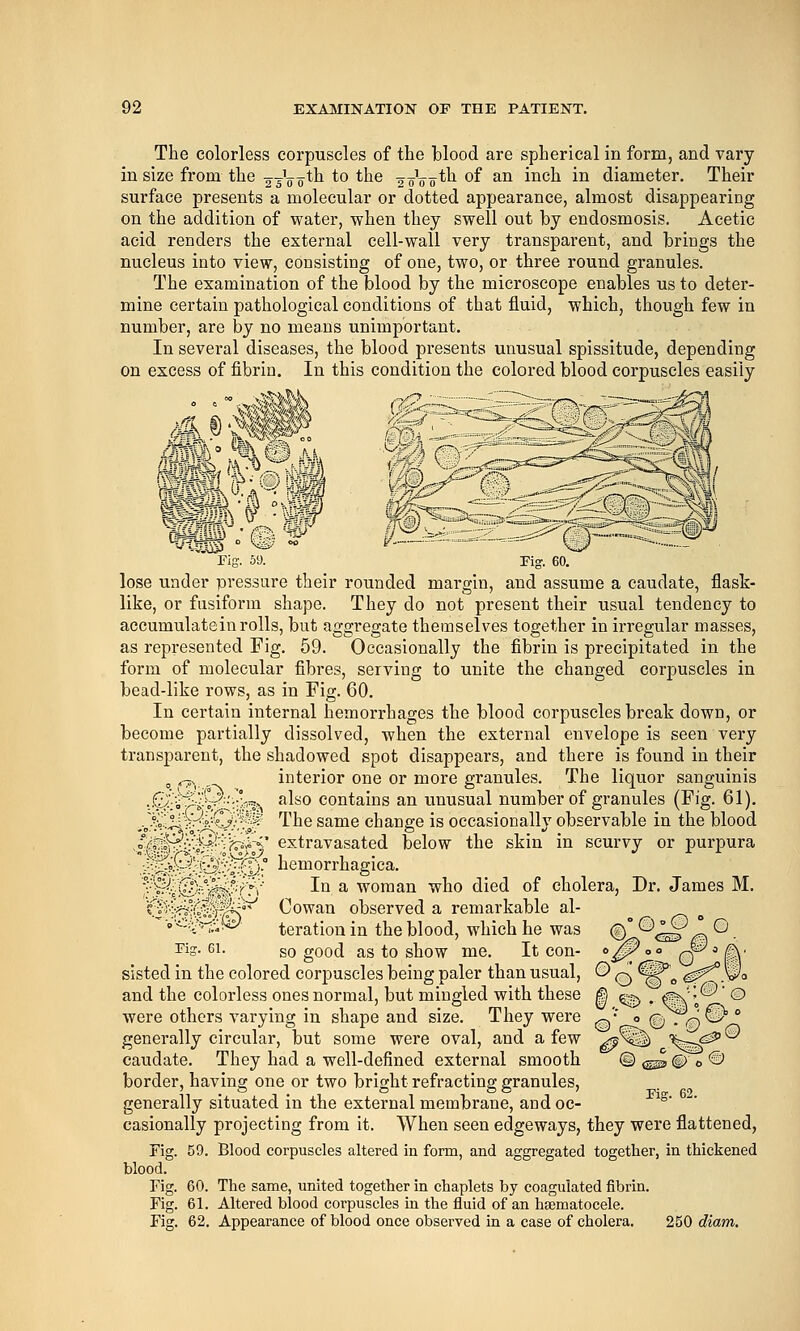 The colorless corpuscles of the blood are spherical in form, and vary in size from the 2 ^V0*^1 to the 2 oVo*li of an inch in diameter. Their surface presents a molecular or dotted appearance, almost disappearing on the addition of water, when they swell out by endosmosis. Acetic acid renders the external cell-wall very transparent, and brings the nucleus into view, consisting of one, two, or three round granules. The examination of the blood by the microscope enables us to deter- mine certain pathological conditions of that fluid, which, though few in number, are by no means unimportant. In several diseases, the blood presents unusual spissitude, depending on excess of fibrin. In this condition the colored blood corpuscles easily W .?%^ M Pig. 69. rig 60. lose under pressure their rouuded margin, and assume a caudate, flask- like, or fusiform shape. They do not piosent their usual tendency to accumulatein rolls, but aggregate themselves together in irregular masses, as represented Fig. 59. Occasionally the fibrin is precipitated in the form of molecular fibres, serving to unite the changed corpuscles in bead-like rows, as in Fig. 60. In certain internal hemorrhages the blood corpuscles break down, or become partially dissolved, when the external envelope is seen very transparent, the shadowed spot disappears, and there is found in their , ^^ ^ interior one or more granules. The liquor sanguinis ■.Q^i'^i''i;=^i;:;°?^^ also contains an unusual number of granules (Fig. 61). -v^^iife^^-'-f^ The same change is occasionally observable in the blood •t^&:^^^-^0^ extravasated below the skin in scurvy or purpura 0^^M^^Bh- hemorrhagica. ^■^.'©V^^ryi- Iq 3, woma iii-^-^^s'Trr -Lu a- woman who died of cholera. Dr. James M. ^^■|^(^S^^ Cowan observed a remarkable al- ^ ^ 'o'^'^^- teration in the blood, which he was %_P^ IS^. Fig. 61. so good as to show me. It con- 0^l° q (i\' sisted in the colored corpuscles being paler than usual, © q @^'^ #5^.Wo and the colorless ones normal, but mingled with these ^ ^sj . ^' '-^' O were others varying in shape and size. They were ^'' <= q r,--i C-)  generally circular, but some were oval, and a few jf^^ \:j^^ caudate. They had a well-defined external smooth © (^^ © e © border, having one or two bright refracting granules, generally situated in the external membrane, and oc- *°' casionally projecting from it. When seen edgeways, they were flattened, Fig. 59. Blood corpuscles altered in form, and aggregated together, in thickened blood. Fig. 60. The same, united together in chaplets by coagulated fibrin. Fig. 61. Altered blood corpuscles in the fluid of an haematocele. Fig. 62. Appearance of blood once observed in a case of cholera. 250 diam.