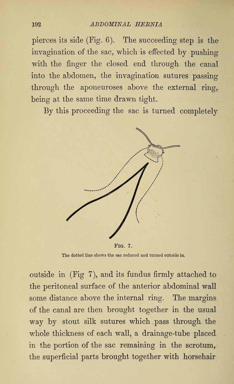 pierces its side (Fig. 6). The succeeding step is tlie invagination of the sac, which is effected by pushing with the finger the closed end through the canal into the abdomen, the invagination sutures passing through the aponeuroses above the external ring, being at the same time drawn tight. By this proceeding the sac is turned completely Fig. 7. The dotted line shows the sac reduced and turned outside in. outside in (Fig 7), and its fundus firmly attached to the peritoneal surface of the anterior abdominal wall some distance above the internal ring. The margins of the canal are then brought together in the usual way by stout silk sutures which .pass through the whole thickness of each wall, a drainage-tube placed in the portion of the sac remaining in the scrotum, the superficial parts brought together with horsehair