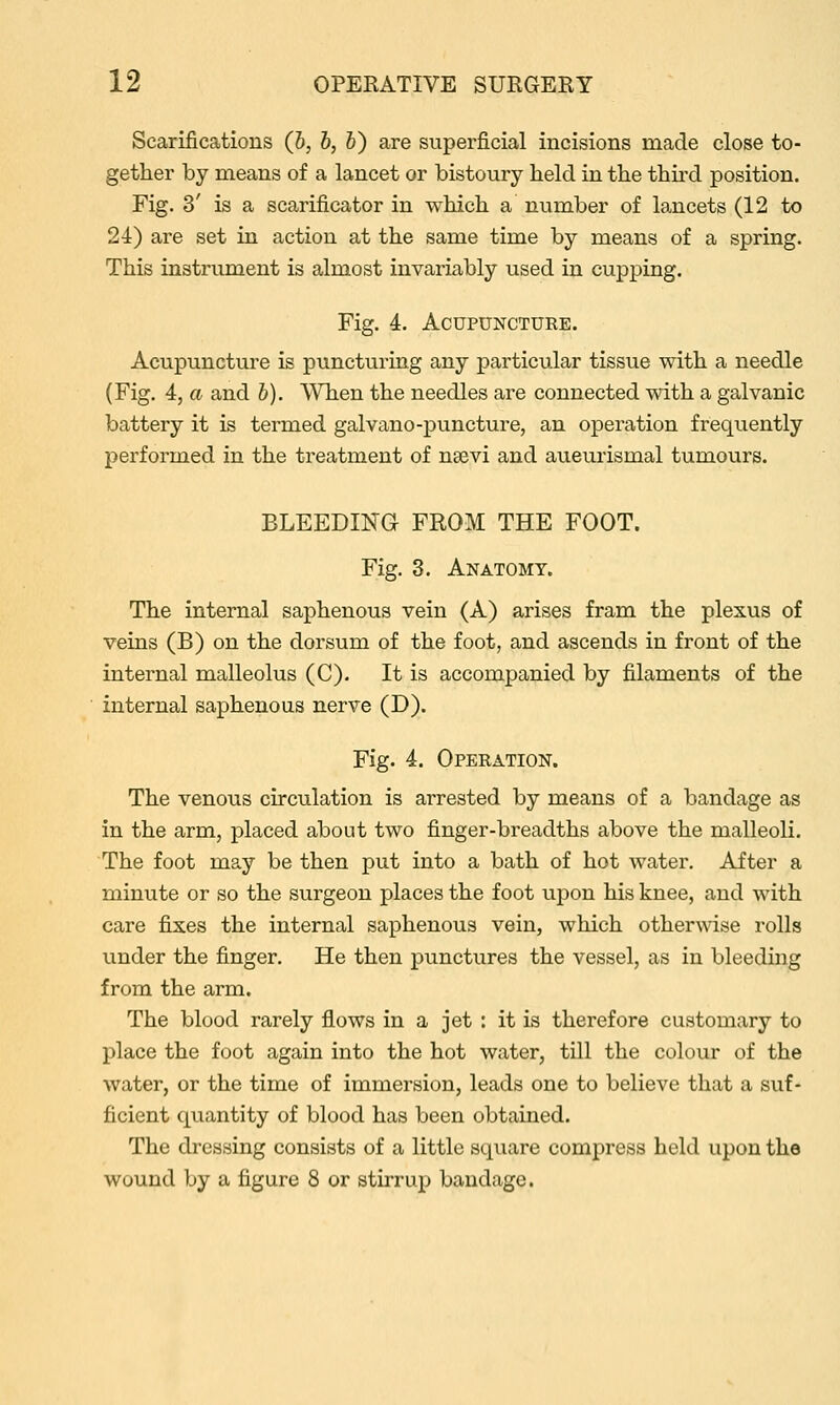 Scarifications (h, b, 6) are superficial incisions made close to- gether by means of a lancet or bistoury held in the third position. Fig. 3' is a scarificator in which a number of lancets (12 to 24) are set in action at the same time by means of a spring. This instrument is almost invariably used in cupping. Fig. 4. Acupuncture. Acupuncture is puncturing any particular tissue with a needle (Fig, 4, a and b). When the needles are connected with a galvanic battery it is termed galvano-puncture, an operation frequently performed in the treatment of nsevi and aueurismal tumours. BLEEDING FROM THE FOOT. Fig. 3. Anatomy. The internal saphenous vein (A) arises fram the plexus of veins (B) on the dorsum of the foot, and ascends in front of the internal malleolus (C). It is accompanied by filaments of the internal saphenous nerve (D). Fig. 4. Operation. The venous circulation is arrested by means of a bandage as in the arm, placed about two finger-breadths above the malleoli. The foot may be then put into a bath of hot water. After a minute or so the surgeon places the foot upon his knee, and with care fixes the internal saphenous vein, which otherwise rolls under the finger. He then punctures the vessel, as in bleeding from the arm. The blood rarely flows in a jet : it is therefore customary to place the foot again into the hot water, till the colour of the water, or the time of immersion, leads one to believe that a suf- ficient qiiantity of blood has been obtained. The dressing consists of a little square compress held upon the wound by a figure 8 or stirrup bandage.