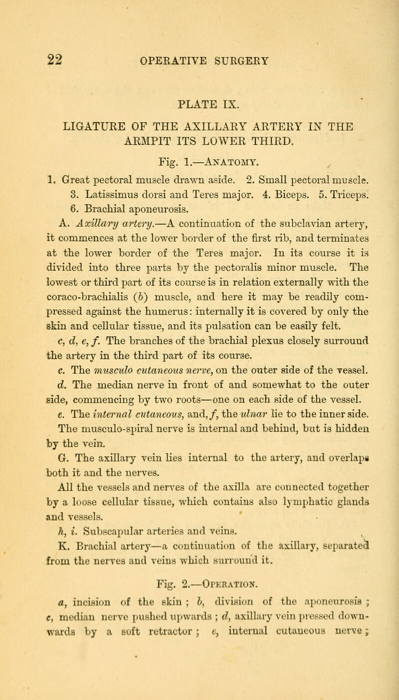 PLATE IX. LIGATURE OF THE AXILLARY ARTERY IN THE ARMPIT ITS LOWER THIRD. Fig. 1.—Anatomy. 1. Great pectoral muscle drawn aside. 2. Small pectoral muscle. 3. Latissimus dorsi and Teres major. 4. Biceps. 5. Triceps. 6. Brachial aponeurosis. A. Axillao'y ai'tery.—A continuation of the subclavian arterj'-, it commences at the lower border of the first rib, and terminates at the lower border of the Teres major. In its course it is divided into three parts by the pectoralis minor muscle. The lowest or third part of its course is in relation externally with the coraco-brachialis (6) muscle, and here it may be readily com- pressed against the humerus: internally it is covered by only the skin and cellular tissue, and its pulsation can be easily felt. c, d, e, f. The branches of the brachial plexus closely surround the artery in the third part of its course, c. The musculo mtaneous nerve, on the outer side of the vessel. d. The median nerve in front of and somewhat to the outer side, commencing by two roots—one on each side of the vessel. €. The internal cutaneous, and,/, the ulnar lie to the inner side. The musculo-spiral nerve is internal and behind, but is hidden by the vein. G. The axillary vein lies internal to the artery, and overlaps both it and the nerves. All the vessels and nerves of the axilla are connected together by a loose cellular tissue, which contains also lymphatic glands and vessels. h, i. Subscapular arteries and veins, K. Brachial artery—a continuation of the axillary, separated from the nerves and veins which surround it. Fig. 2.—Operation. a, incision of the skin ; h, division of the aponeurosis ; e, median nerve pushed upwards ; d, axillary vein pressed down- wards by a soft retractor ; c, internal cutaneous nerve;