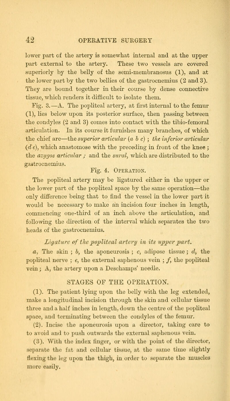 lower part of the artery is somewhat internal and at the upper part external to the artery. These two vessels are covered, superiorly by the belly of the semi-membi'anosns (1), and at the lower part by the two bellies of the gastrocnemius (2 and 3). They are bound together in their course by dense connective tissue, which renders it difficult to isolate them. Fig. 3.—A. The popliteal artery, at first internal to the femur (1), lies below upon its posterior surface, then passing between the condyles (2 and 3) comes into contact Tsith the tibio-femoral ai-ticulation. In its coui'se it furnishes many branches, of which the chief are—the superior articular [ah c) ; the inferior articular {d e), which anastomose with the preceding in front of the knee ; the azygos articular ; and the sii^ral, which are distributed to the gastrocnemius. Fig. 4. Operation. The popliteal artery may be ligatured either in the upper or the lower part of the popliteal space by the same operation—the only difference being that to find the vessel in the lower part it would be necessary to make an incision four inches in length, commencing one-third of an inch above the articulation, and following the direction of the interval which separates the two heads of the gastrocnemius. Ligature of tlie ])oi)liteal artery in its iqj}^^^ J^cirt. a, The skin ; h, the aponeurosis ; c, adipose tissue; d, the popliteal nerve ; e, the external saphenous vein ; /, the popliteal vein; A, the artery upon a Deschamps' needle. STAGES OF THE OPERATION. (1). The patient lying upon the belly with the leg extended, make a longitudinal incision through the skin and cellular tissue three and a half inches in length, down the centre of the popliteal space, and terminating between the condyles of the femur. (2). Incise the aponeurosis upon a du-ector, taking care to to avoid and to push outwards the external saphenous vein. (3). With the index finger, or with the point of the director, separate the fat and cellular tissue, at the same time slightly flexing the leg upon the thigh, in order to separate the muscles more easily.