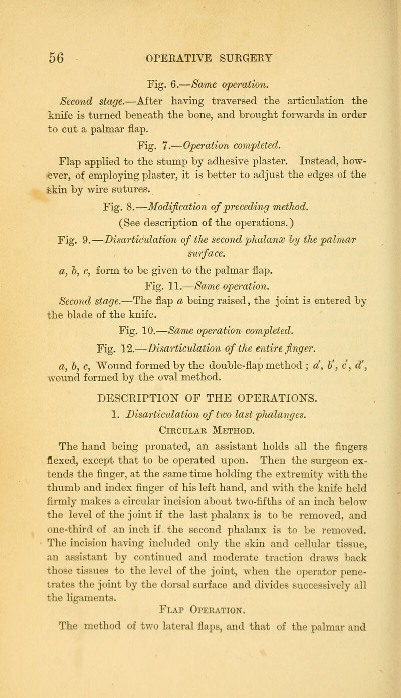 Fig. 6.—Same operation. Second stage.—After having traversed the articulation the knife is turned beneath the bone, and brought forwards in order to cut a palmar flap. Fig. 7.—Operation completed. Flap applied to the stump by adhesive plaster. Instead, hov7- «ver, of employing plaster, it is better to adjust the edges of the skin by wii'e sutures. Fig. 8.—Modification of preceding method. (See description of the operations.) Fig. 9.—Disarticidation of the second phalanx hy the palmar surface. a, 5, c, form to be given to the palmar flap. Fig. 11.—Same operation. Second stage.—The flap a being raised, the joint is entered by the blade of the knife. Fig. 10.—Same operation completed. Fig. 12.—Disarticidation of the entire finger. a, h, c, Wound formed by the double-flap method ; a, h', c, d', wound formed by the oval method. DESCRIPTION OF THE OPERATIONS. 1. Disarticulation of two last phalanges. Circular Method. The hand being pronated, an assistant holds all the fingers flexed, except that to be operated upon. Then the surgeon ex- tends the finger, at the same time holding the extremity with the thumb and index finger of his left hand, and with the knife held firmly makes a circular incision about two-fifths of an inch below the level of the joint if the last phalanx is to be removed, and one-third of an inch if the second phalanx is to be removed. The incision having included only the skin and cellular tissue, an assistant by continued and moderate traction draws back those tissues to the level of the joint, Avhen the operator pene- trates the joint by the dorsal surface and divides successively all the ligaments. Flap Operation. The method of two lateral flaps, and that of the palmar and