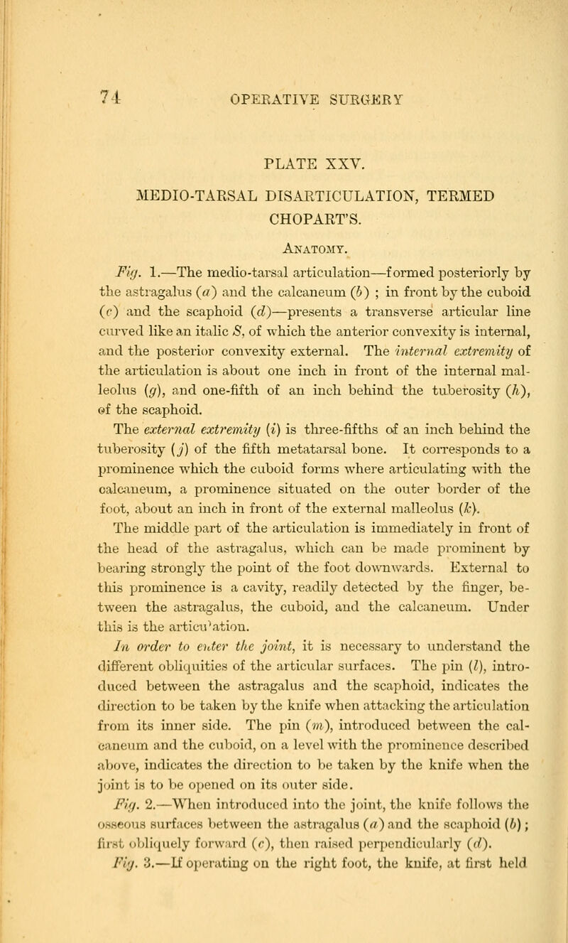 PLATE XXV, MEDIO-TARSAL DISARTICULATION, TERMED CHOPART'S. Anatomy. Fig. 1.—The medio-tarsal articulation—formed posteriorly by the astragalus (</) and the calcaneum (6) ; in front by the cuboid (r) and the scaphoid (d)—pi'esents a transverse articular line curved like an italic S, of which the anterior convexity is internal, and the posterior convexity external. The internal extremity of the articulation is about one inch in front of the internal mal- leolus {g), and one-fifth of an inch behind the tuberosity Qi), ©f the scaphoid. The external extremity (^) is three-fifths of an inch behind the tuberosity {j) of the fifth metatarsal bone. It coiTesponds to a prominence which the cuboid forms where articulating with the oalGxneum, a prominence situated on the outer border of the friot, about an inch in front of the external malleolus {Tc). The middle part of the articulation is immediately in front of the head of the asti'agalus, which can be made prominent by bearing strongly the point of the foot downAvards. External to this prominence is a cavity, readily detected by the finger, be- tween the astragalus, the cuboid, and the calcaneum. Under this is the articulation. In order to eider the joint, it is necessary to understand the different obliquities of the articular surfaces. The pin {I), intro- duced between the astragalus and the scaphoid, indicates the direction to be taken by the knife when attacking the articulation from its inner side. The pin (m), introduced between the cal- caneum and the cuboid, on a level with the prominence described above, indicates the direction to be taken by the knife when the joint is to be opened on its outer side. Fig. 2.—When introduced into the joint, the knife follows the osseous surfaces between the astragalus (a) and the scaphoid {b); first (jbliquely forward (c), then raised perpendicularly (d). Fig. 3.—If operating on the right foot, the knife, at first held