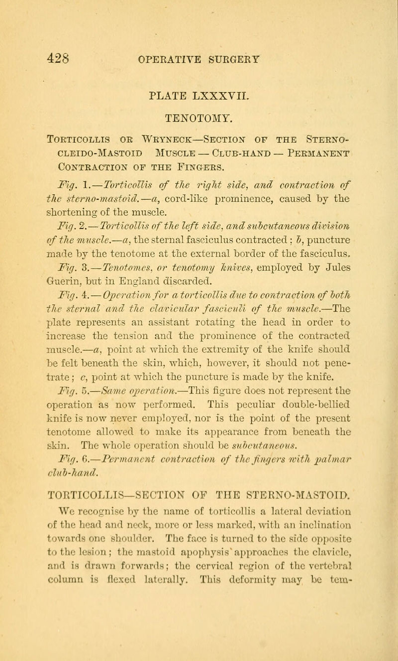 PLATE LXXXVII. TENOTOMY. Torticollis oe Wryneck—Section of the Sterno- cleido-Mastoid Muscle — Club-hand — Permanent Contraction of the Fingers. Fig. 1.—Toj'ticoUis of the right side, and contraction of tlic sterno-mastoid.—a, cord-like prominence, caused by the shortening of the muscle. Fig. 2.—ToHicollis oftJie left side, andsuhcutaneovs dimsion of the mnscle.—a, the sternal fasciculus contracted; d, puncture made by the tenotome at the external border of the fasciculus. Fig. 3,—Tenotomes, or tenotomy 'knives, employed by Jules Guerin, but in England discarded. Fig. 4. — Operation for a torticollis dne to contraction of Ijoth the sternal and the clavicular fascicvU of the mvscle.—The plate represents an assistant rotating the head in order to increase the tension and the prominence of the contracted muscle.—a, point at which the extremity of the knife should be felt beneath the skin, which, however, it should not pene- trate ; <?, point at which the puncture is made by the knife. Fig. 5.—Same operation.—This figure does not represent the operation as now performed. This peculiar double-bellied knife is now never employed, nor is the point of the present tenotome allowed to make its appearance from beneath the skin. The whole operation should be subcutaneous. Fig. 6.—Permanent contraction of the fingers with 2}almar cluh-hajid. TORTICOLLIS—SECTION OF THE STERNO-MASTOID. We recognise by the name of torticollis a lateral deviation of the head and neck, more or less marked, ^vith an inclination towards one shoulder. The face is turned to the side opposite to the lesion; the mastoid apophysis'approaches the clavicle, and is drawn forwards; the cervical region of the vertebral column is flexed laterally. This deformity niay be tcm-