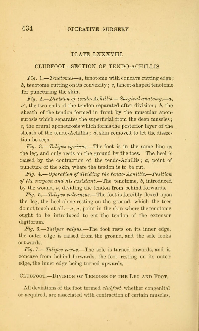 PLATE LXXXVIII. CLUBFOOT—SECTION OF TENDO-ACHILLIS. Fig. 1.—Tenotomes—a, tenotome with concave cutting edge ; h, tenotome cutting on its convexity; <?, lancet-shaped tenotome for puncturing the skin. Fig. 2.—Division of tendo-AcMllis.— Surgical anatomy.—a, a', the two ends of the tendon separated after division ; h, the sheath of the tendon formed, in front by the muscular apon- eurosis which separates the superficial from the deep muscles ; c, the crural aponeurosis which forms the posterior layer of the sheath of the tendo-Achillis ; d, skin removed, to let the dissec- tion be seen. Fig. 3.—Talipes equinus.—The foot is in the same line as the leg, and only rests on the ground by the toes. The heel is raised by the contraction of the tendo-Achillis ; a, point of puncture of the skin, where the tendon is to be cut. Fig. 4.— Ojfcration of dividing the tendo-Acliillis.—Position of tJie surgeon and 7ns assistant.—The tenotome, b, introduced by the wound, a, dividing the tendon from behind forwards. Fig. 5.—Talipes calcaneus.—The foot is forcibly flexed upon the leg, the heel alone resting on the ground, which the toes do not touch at all.—a, a, point in the skin where the tenotome ought to be introduced to cut the tendon of the extensor digitorum. Fig. 6.— Talipes valgus.—The foot rests on its inner edge, the outer edge is raised from the ground, and the sole looks outwards. Fig. 7.—Talipes varus.—The sole is turned inwards, and is concave from behind forwards, the foot resting on its outer edge, the inner edge being turned upwards. Clubfoot.—Division of Tendons of the Leg and Foot. All deviations of the foot termed cluhfoot, whether congenital or acc^uired, are associated with contraction of certain muscles,