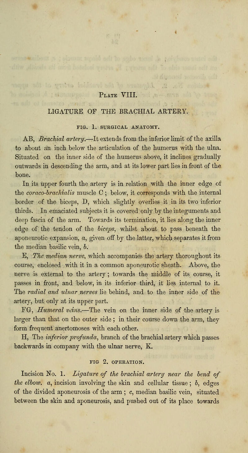 Plate VIII. LIGATURE OF THE BRACHIAL ARTERY. FIG. 1. SURGICAL ANATOMY. AB, Brachial artery.—It extends from the inferior limit of the axilla to about an inch below the articulation of the humerus with the ulna. Situated on the inner side of the humerus above, it inclines gradually outwards in descending the arm, and at its lower part lies in front of the. bone. In its upper fourth the artery is in relation with the inner edge of the coraco-brachialis muscle C ; below, it corresponds with the internal border of the biceps, D, which slightly overlies it in its two inferior thirds. In emaciated subjects it is covered only by the integuments and deep fascia of the arm. Towards its termination, it lies along the inner edge of the tendon of the biceps, whilst about to pass beneath the aponeurotic expansion, a, given off by the latter, which separates it from the median basilic vein, b. E, The median nerve, which accompanies the artery thoroughout its course, enclosed with it in a common aponeurotic sheath. Above, the nerve is external to the artery ; towards the middle of its course, it passes in front, and below, in its inferior third, it lies internal to it. The radial and ulnar nerves lie behind, and to the inner side of the artery, but only at its upper part. FG, Humeral veins.—The vein on the inner side of the artery is larger than that on the outer side; in their course down the arm, they form frequent anertomoses with each other. H, The inferior profunda, branch of the brachial artery which passes backwards in company with the ulnar nerve, K. FIG 2. OPERATION. Incision No. 1. Ligature of the brachial artery near the bend of the elbow, a, incision involving the skin and cellular tissue; b, edges of the divided aponeurosis of the arm ; c, median basilic vein, situated between the skin and aponeurosis, and pushed out of its place towards